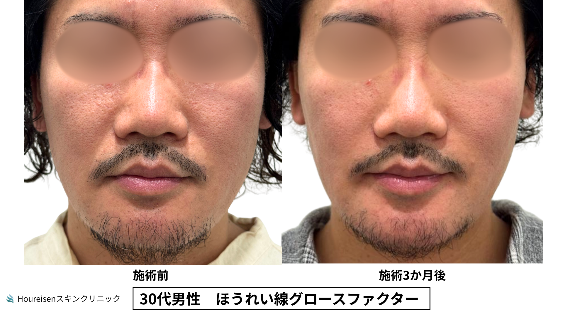 30代男性 ほうれい線 グロースファクター 施術前と3か月後