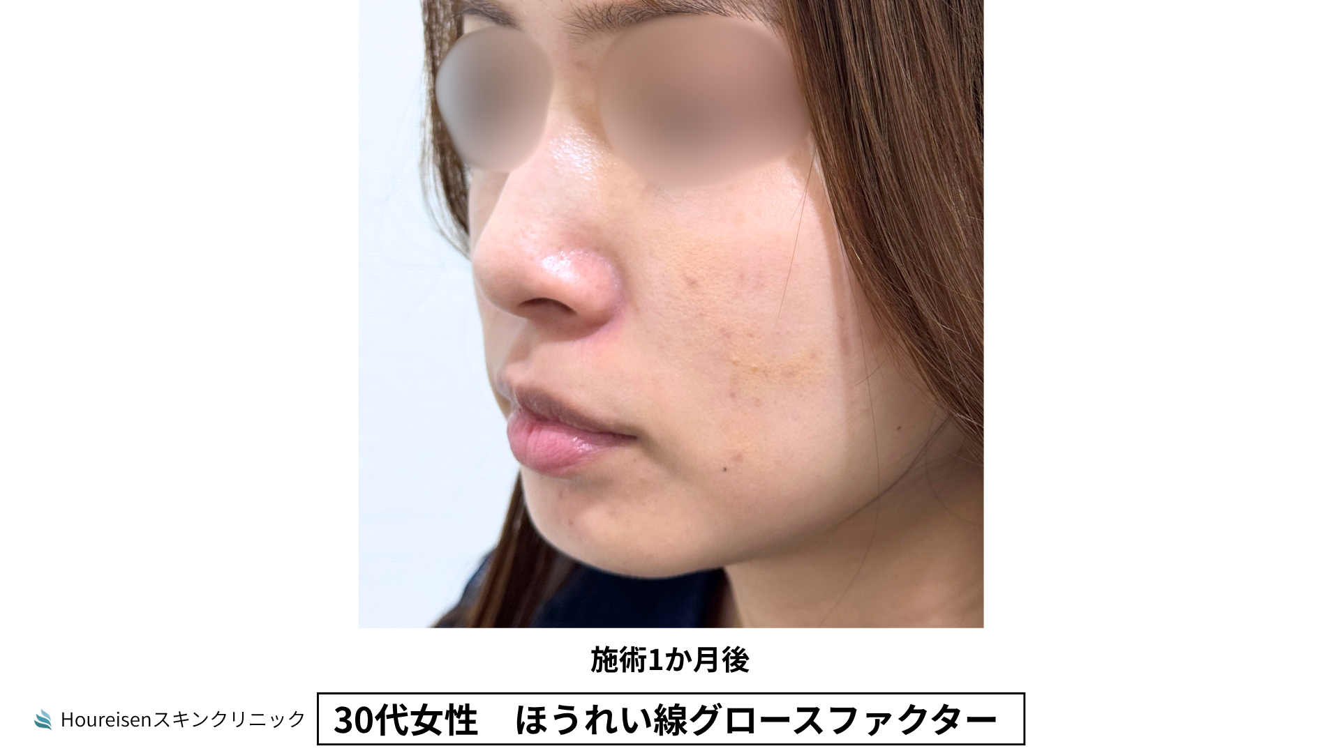 30代女性 ほうれい線グロースファクター施術1か月後