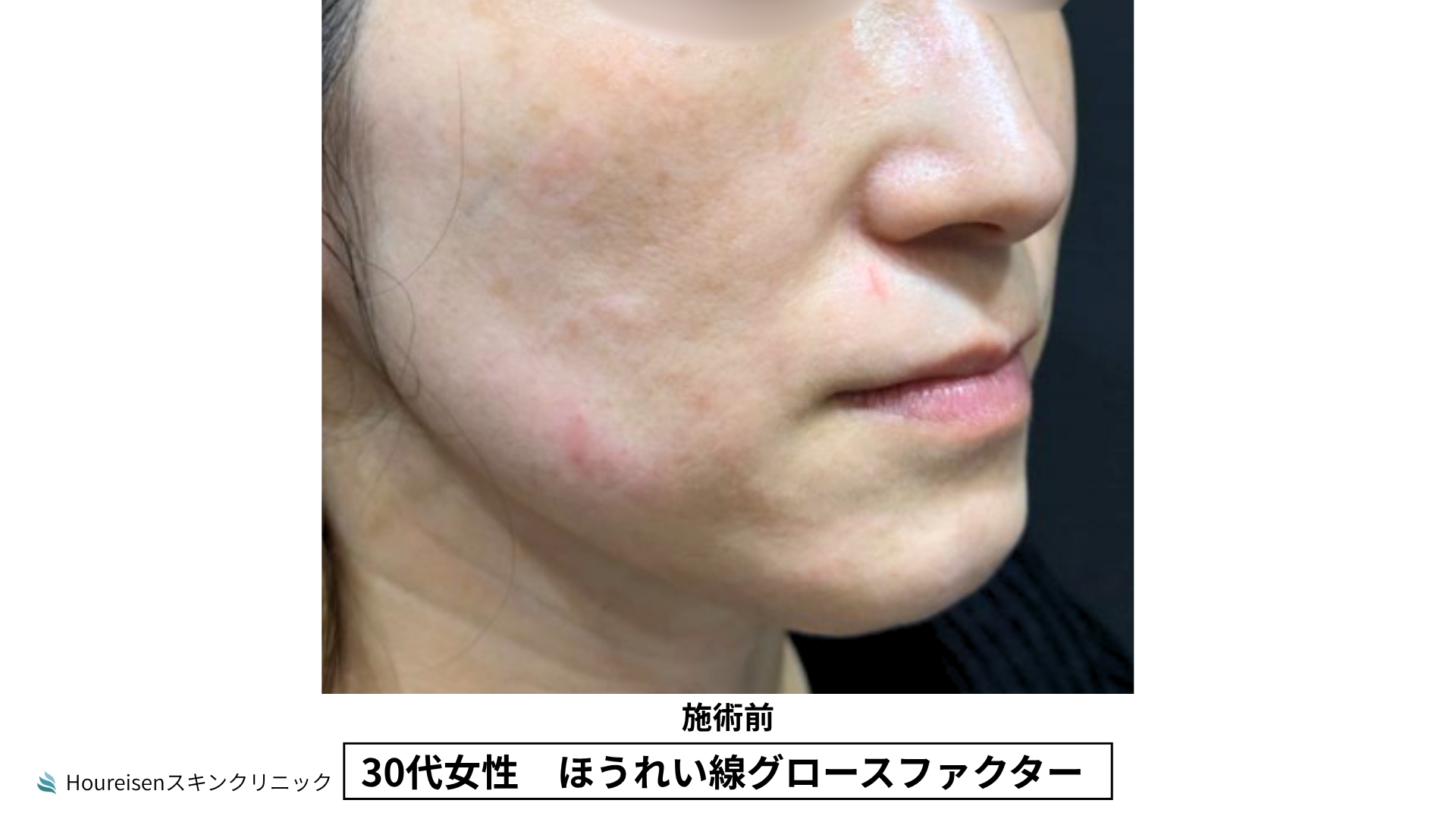 30代女性 ほうれい線グロースファクター施術前