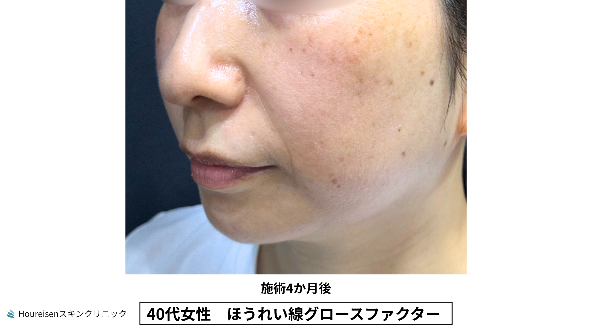 40代女性 ほうれい線グロースファクター施術4か月後