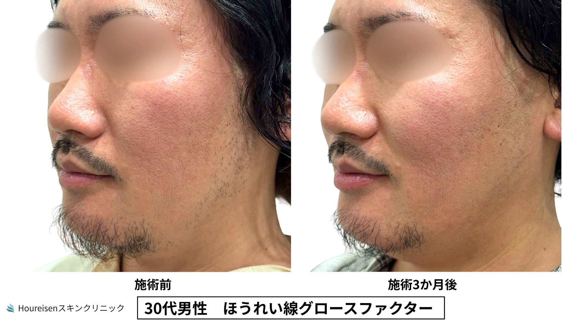 30代男性 ほうれい線 グロースファクター 症例比較