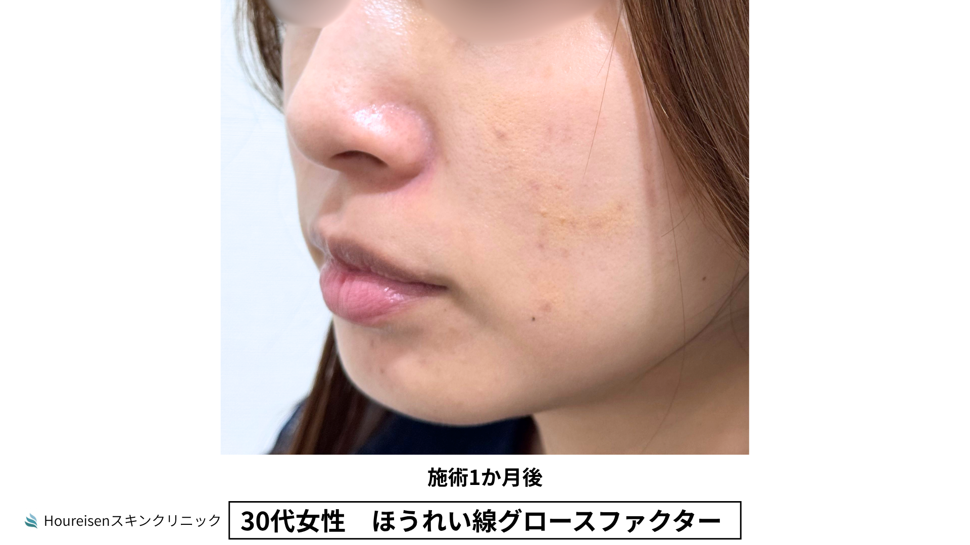 30代女性 ほうれい線グロースファクター施術1か月後