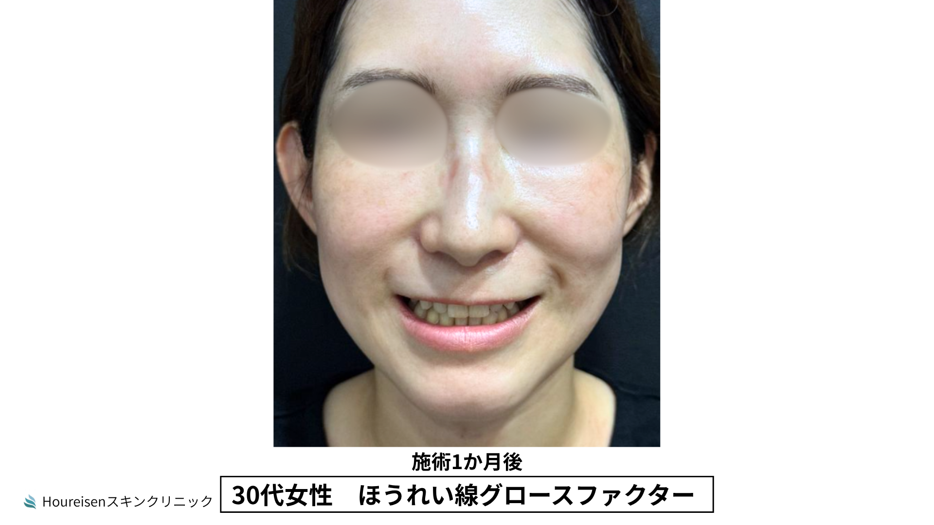 30代女性 ほうれい線グロースファクター施術3か月後
