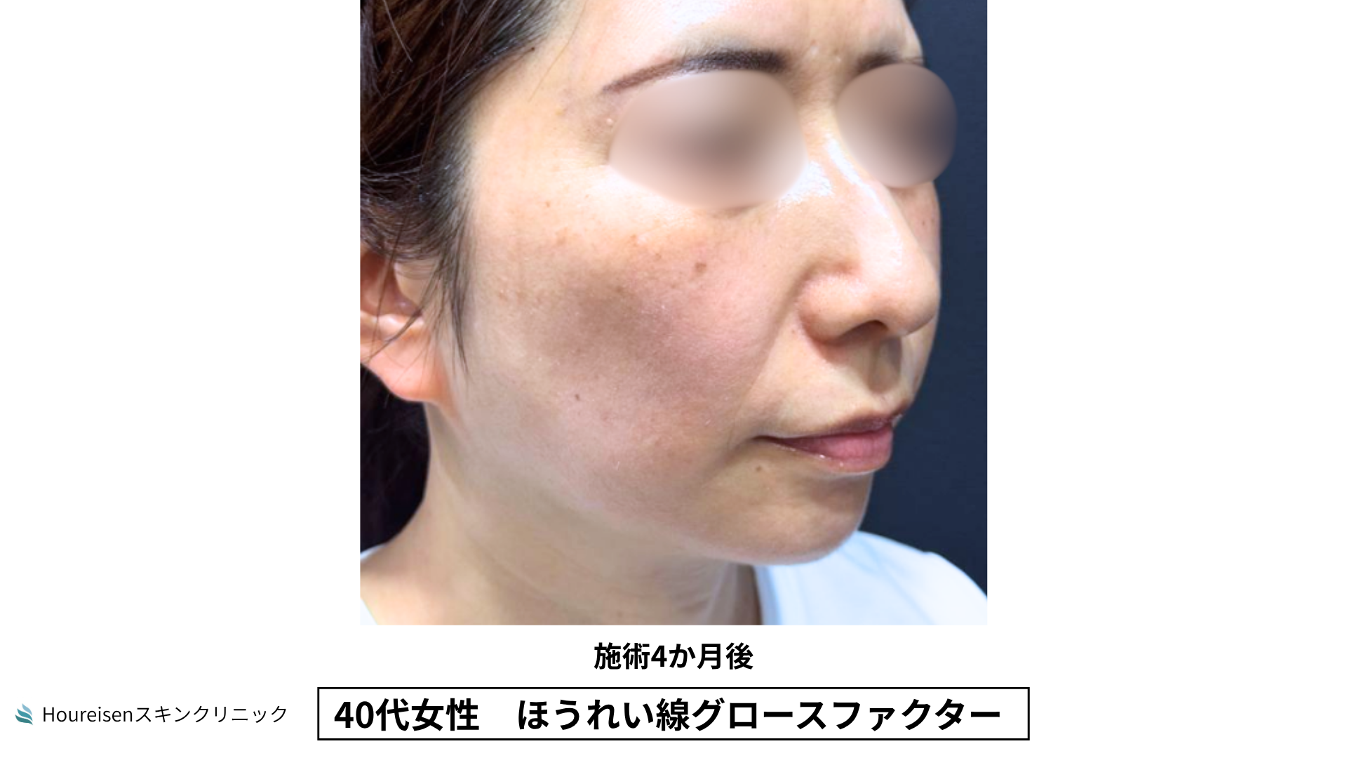 40代女性 ほうれい線グロースファクター施術4か月後