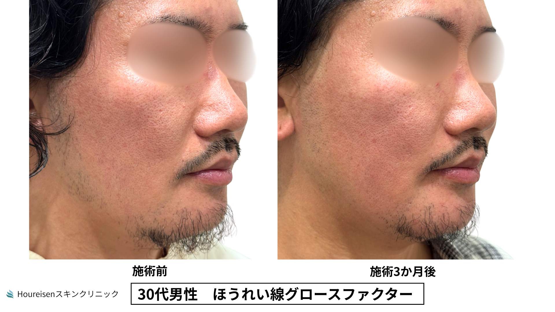 30代男性 ほうれい線 グロースファクター 症例比較