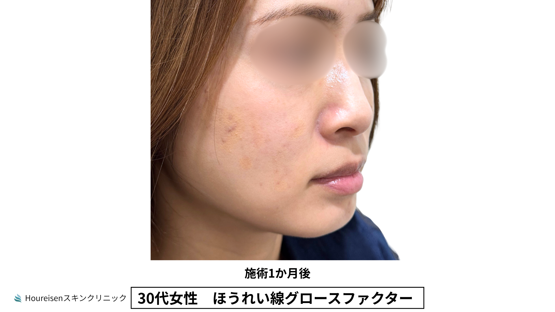 30代女性 ほうれい線グロースファクター施術1か月後