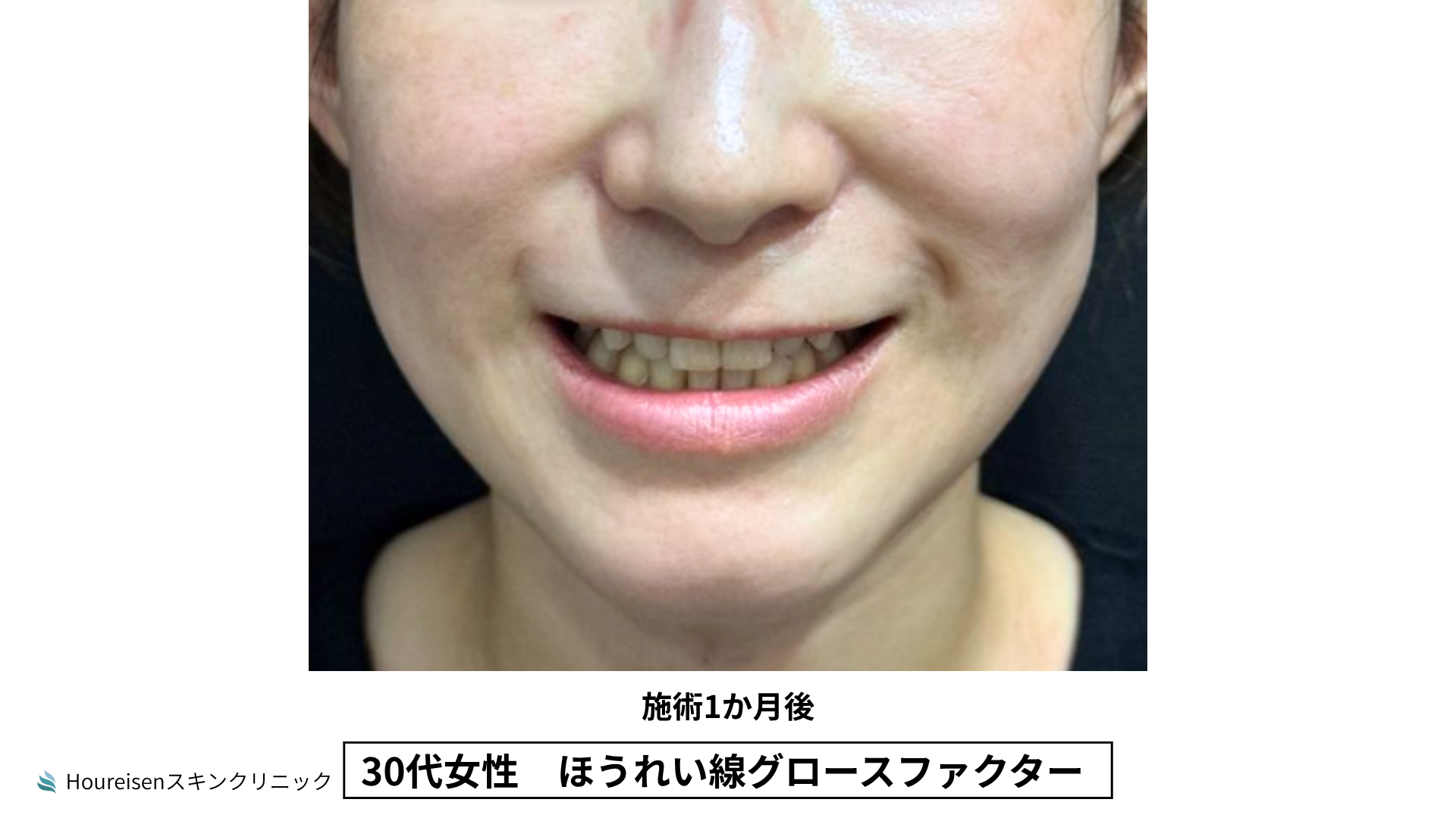 30代女性 ほうれい線グロースファクター施術3か月後