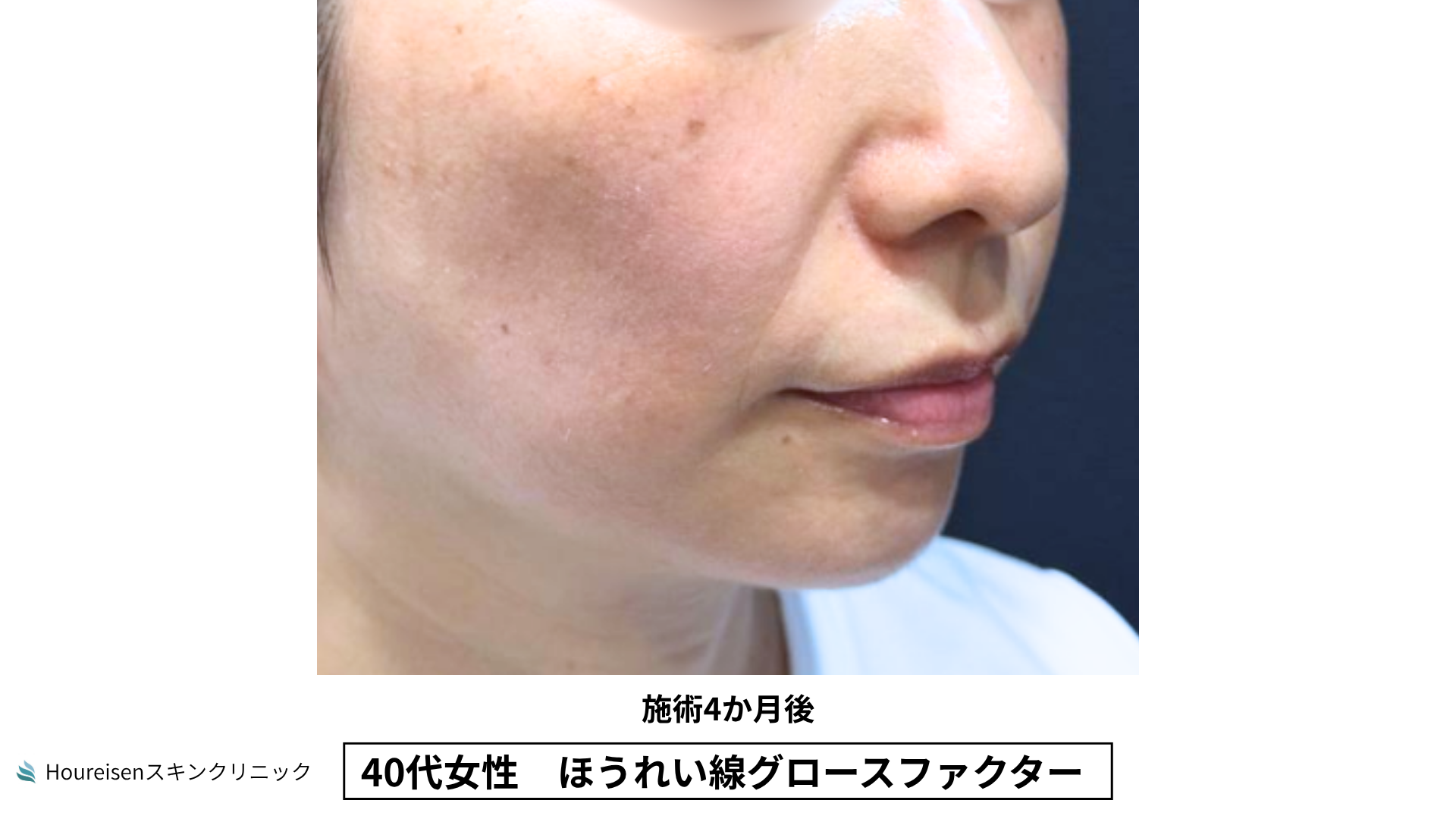 40代女性 ほうれい線グロースファクター施術4か月後