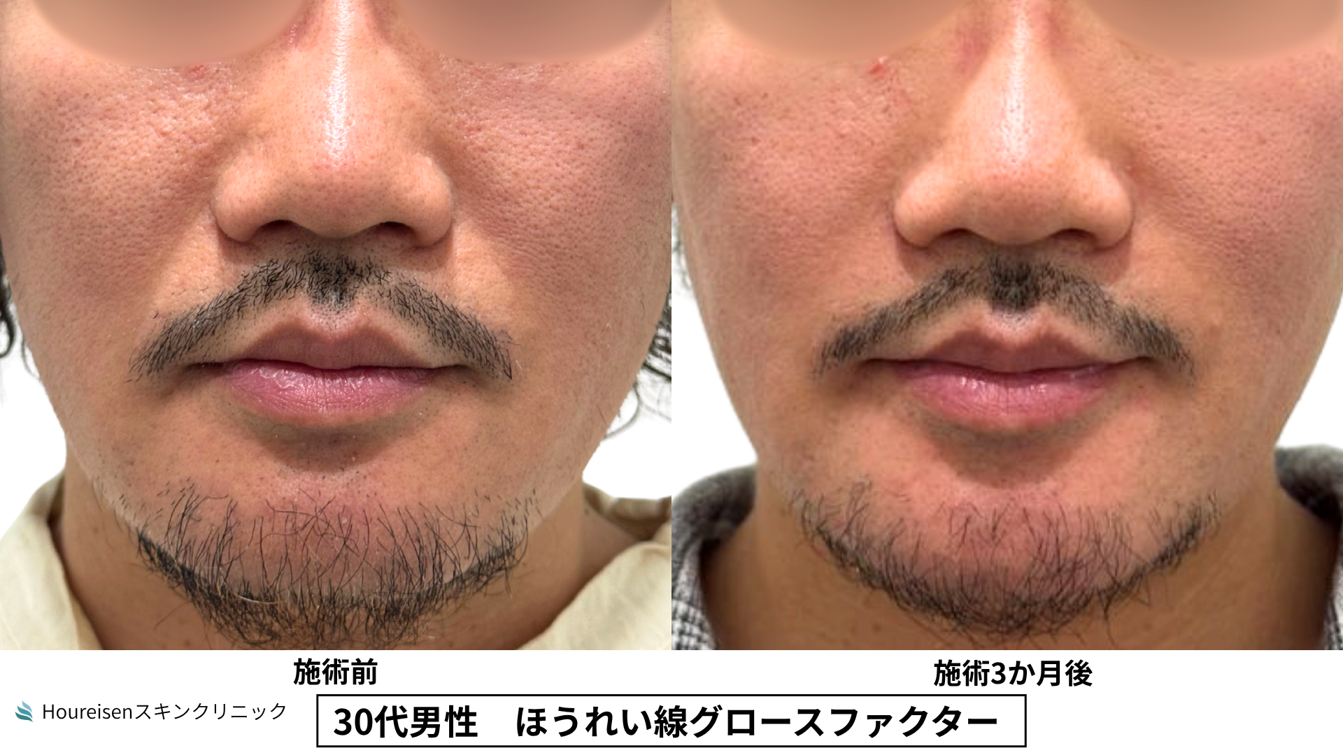 30代男性 ほうれい線 グロースファクター 症例比較