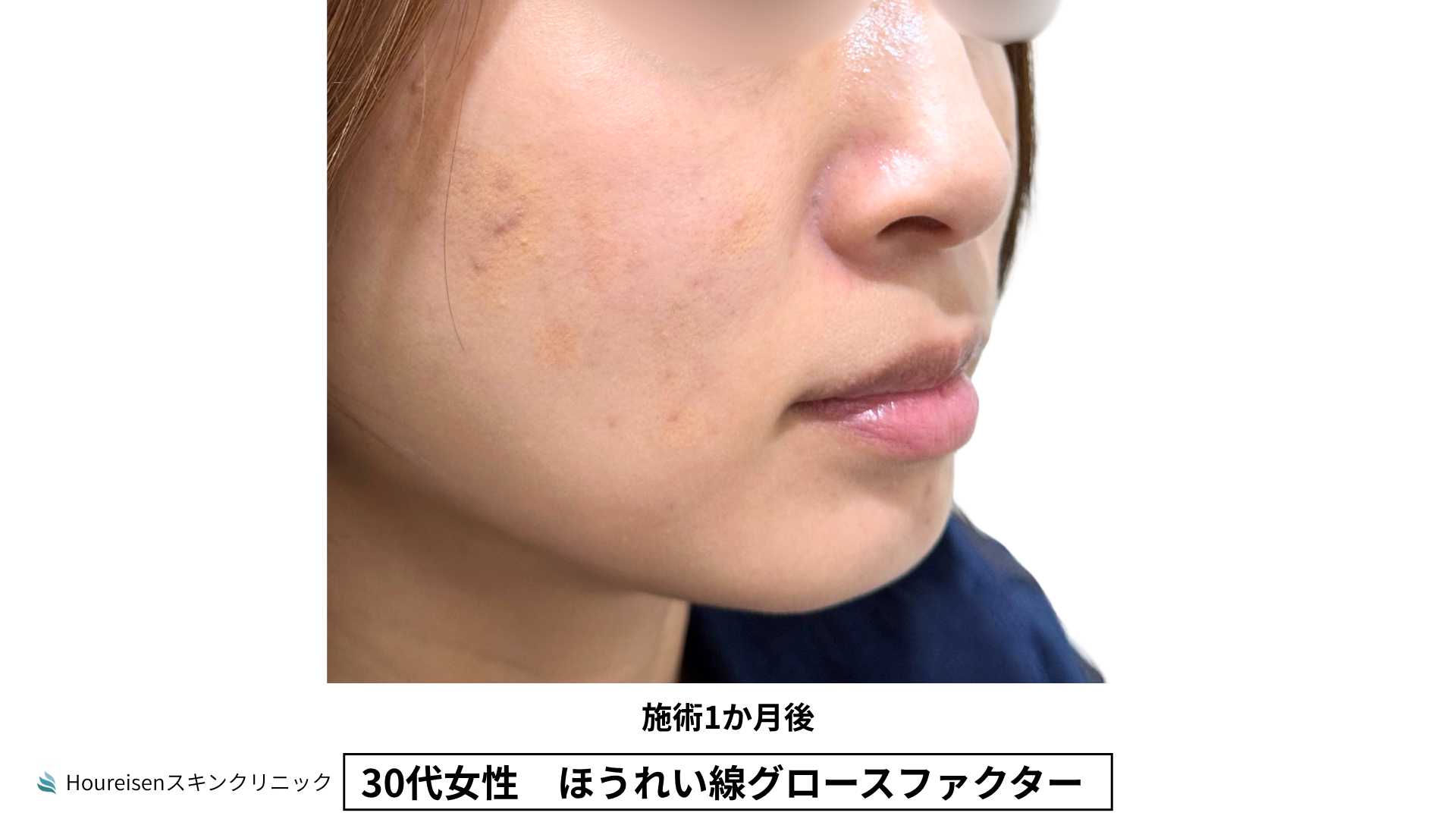 30代女性 ほうれい線グロースファクター施術1か月後