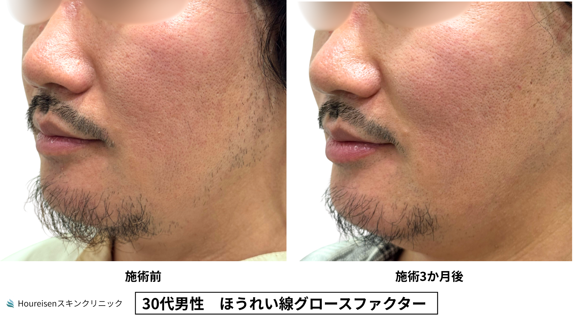 30代男性 ほうれい線 グロースファクター 症例比較