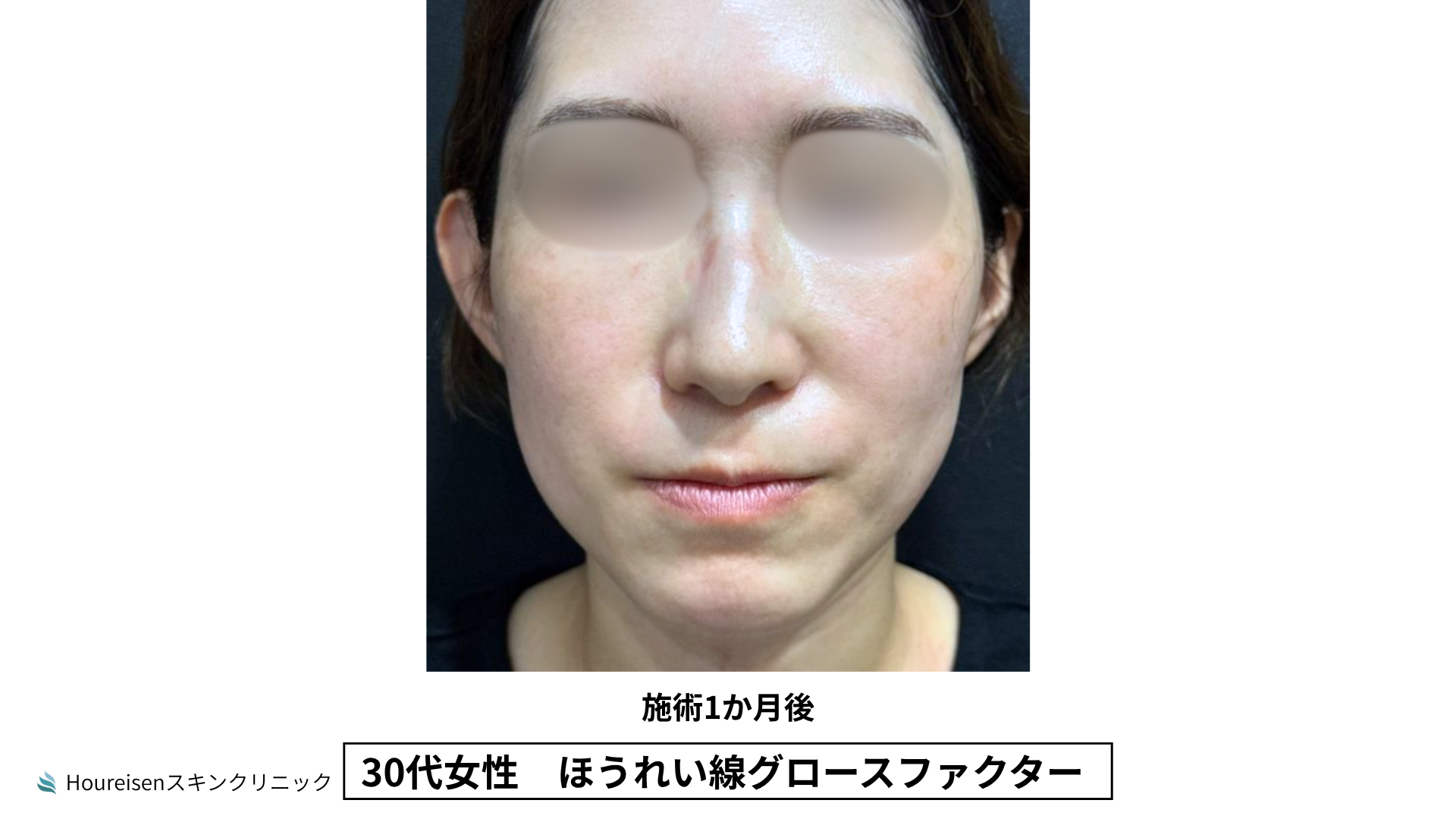 30代女性 ほうれい線グロースファクター施術3か月後