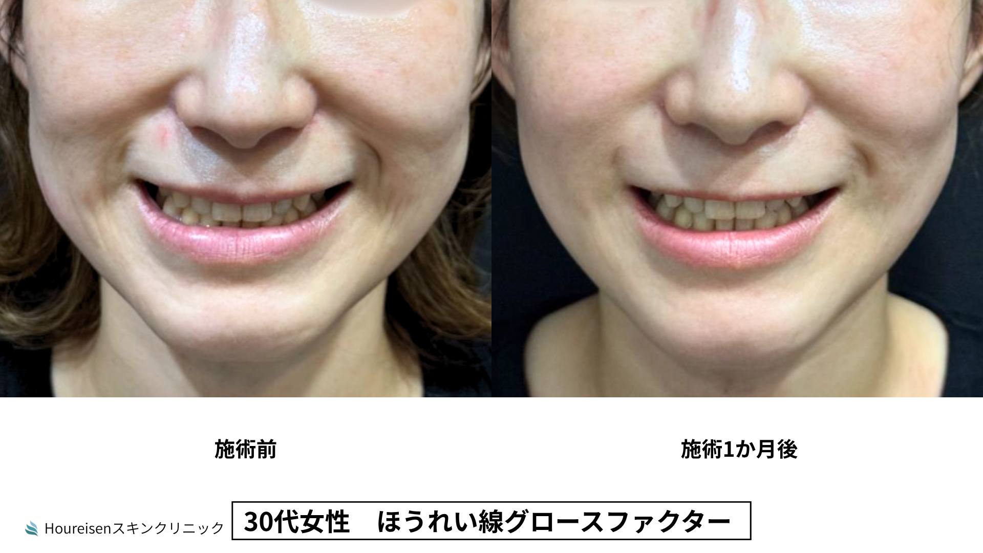 30代女性 グロースファクター3か月後 症例比較