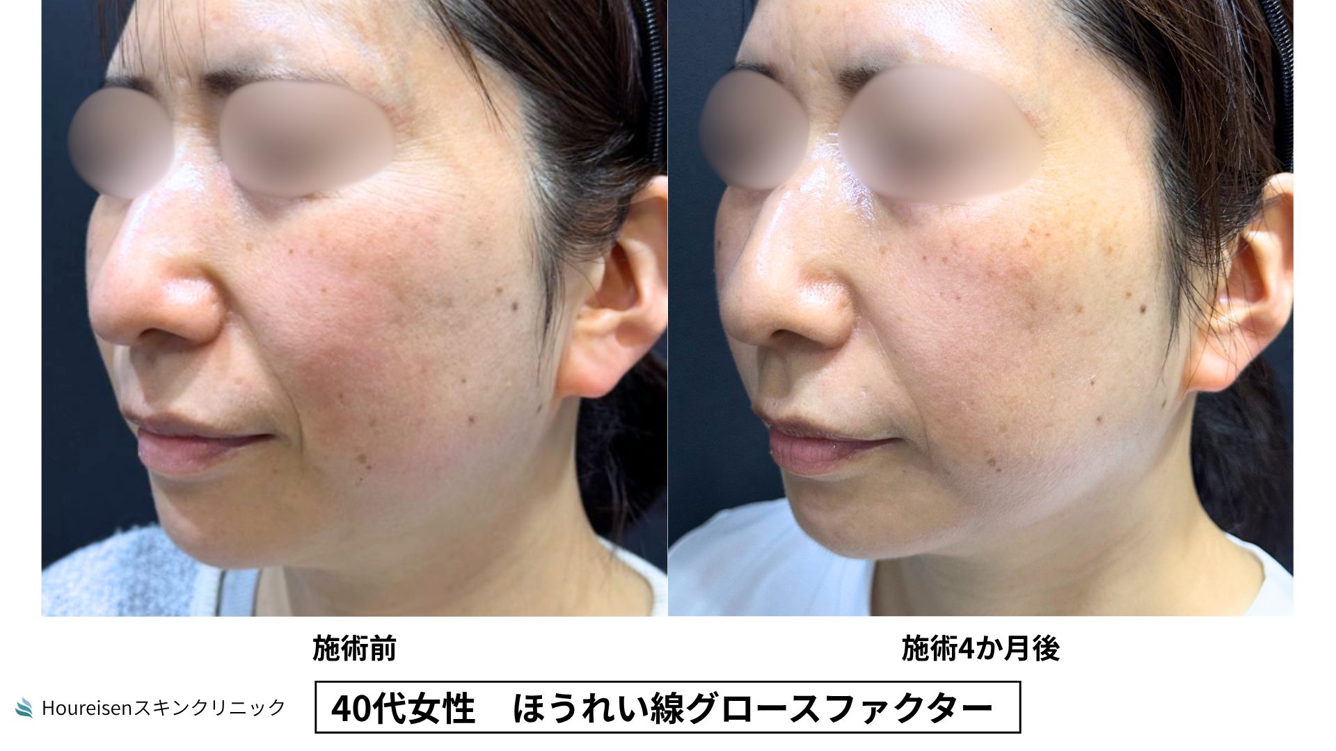 40代女性 ほうれい線グロースファクター4か月後 症例比較