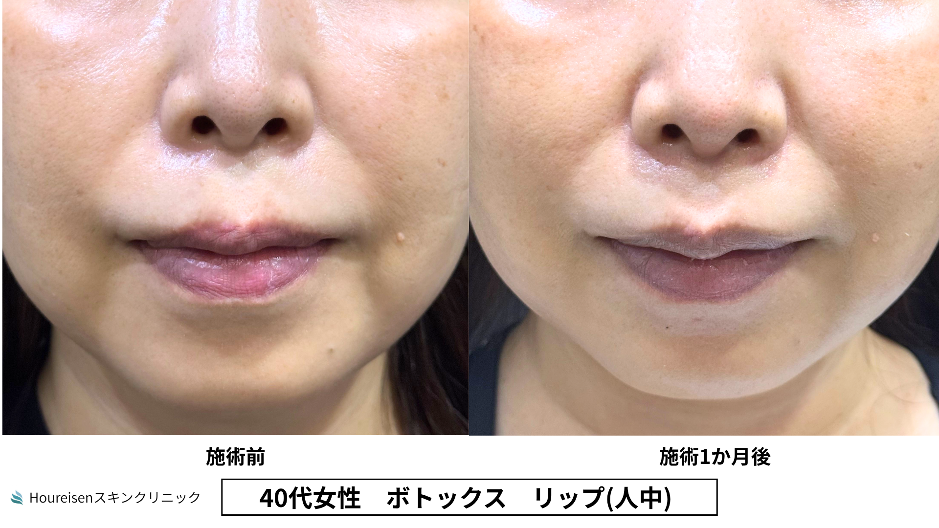 40代女性 リップ人中ボトックス 症例比較