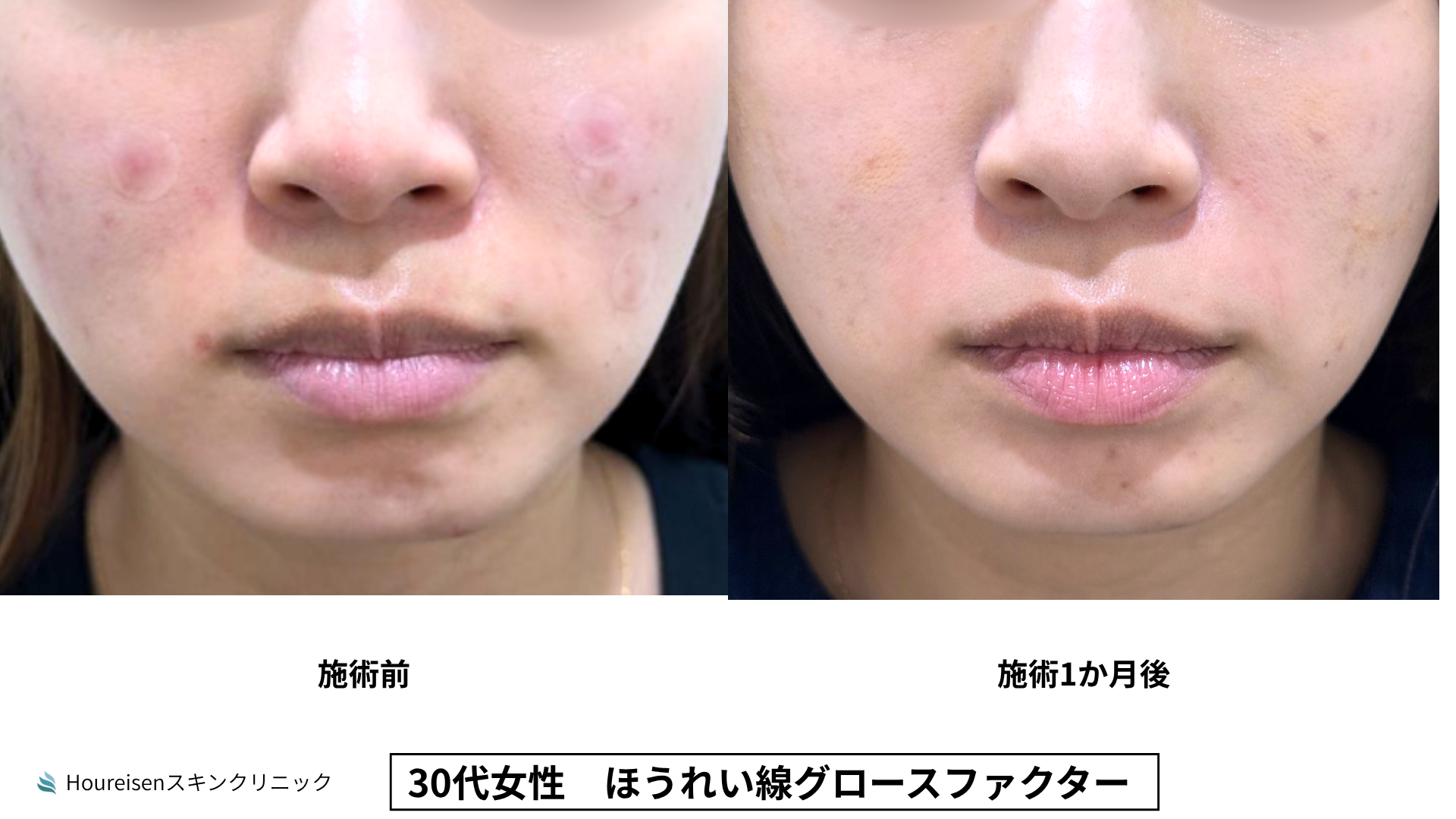 30代女性 ほうれい線グロースファクター症例比較