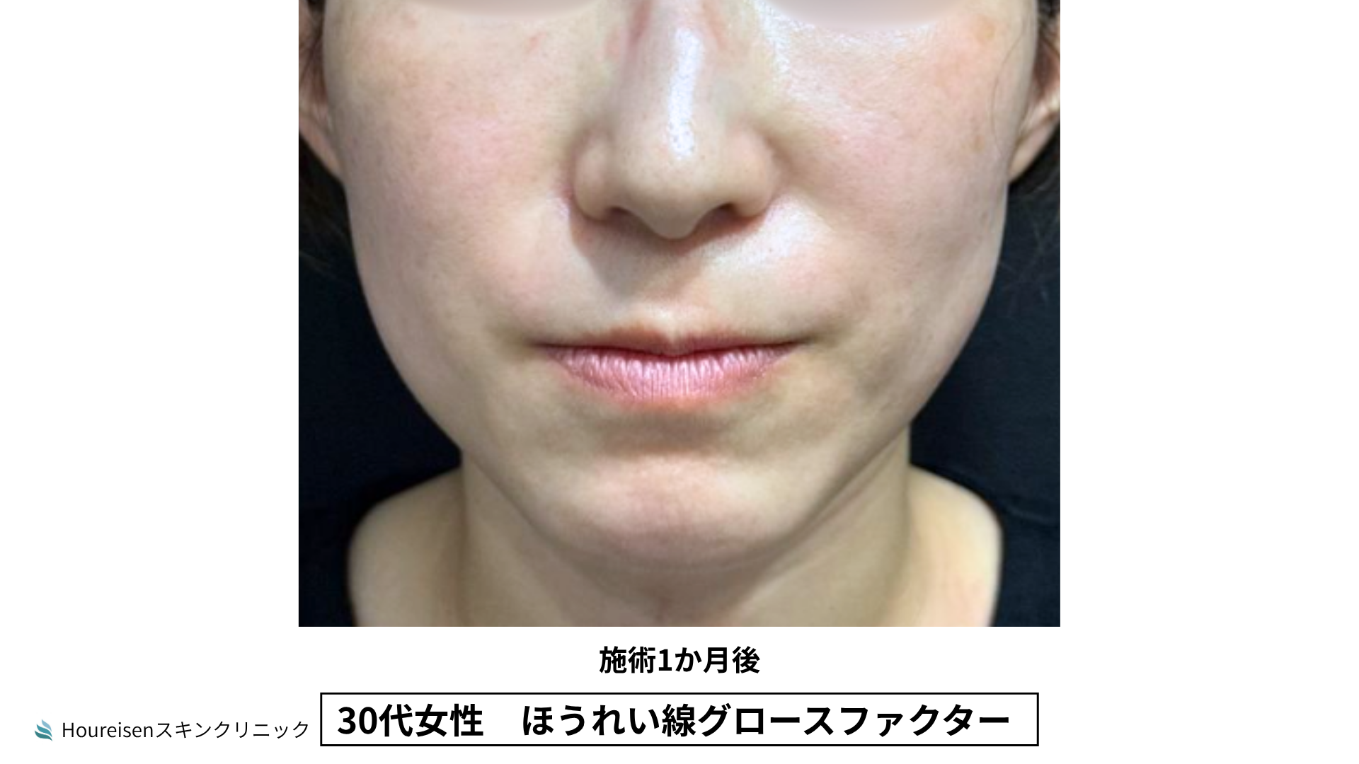 30代女性 ほうれい線グロースファクター施術3か月後