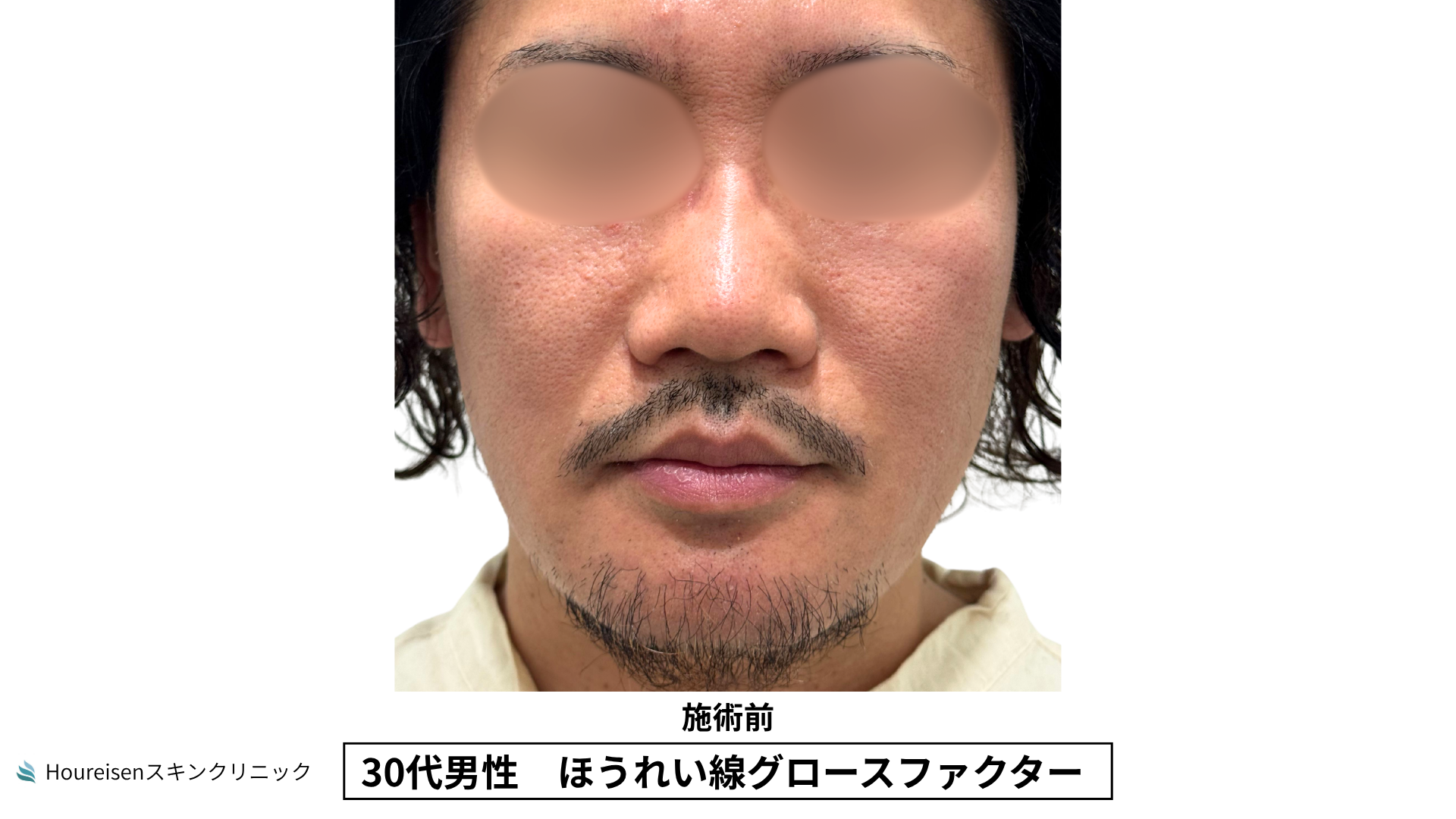 30代男性 ほうれい線 グロースファクター 施術前