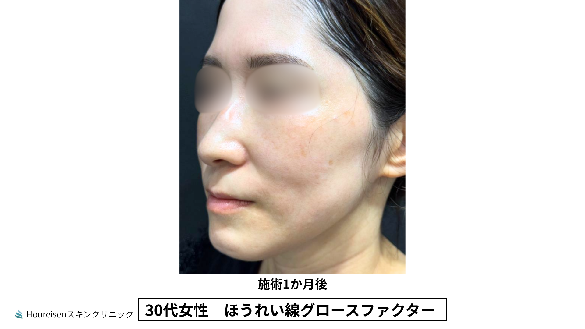 30代女性 ほうれい線グロースファクター施術3か月後