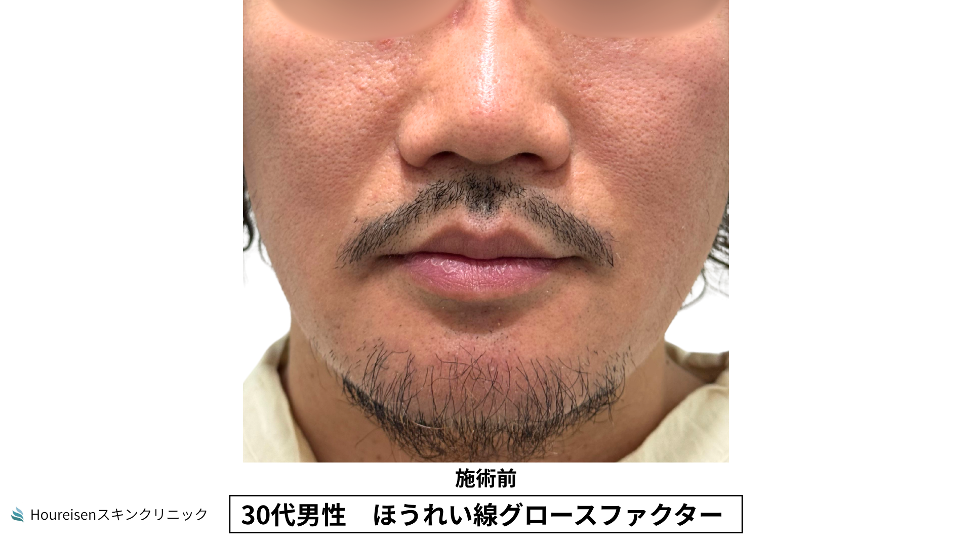30代男性 ほうれい線 グロースファクター 施術前