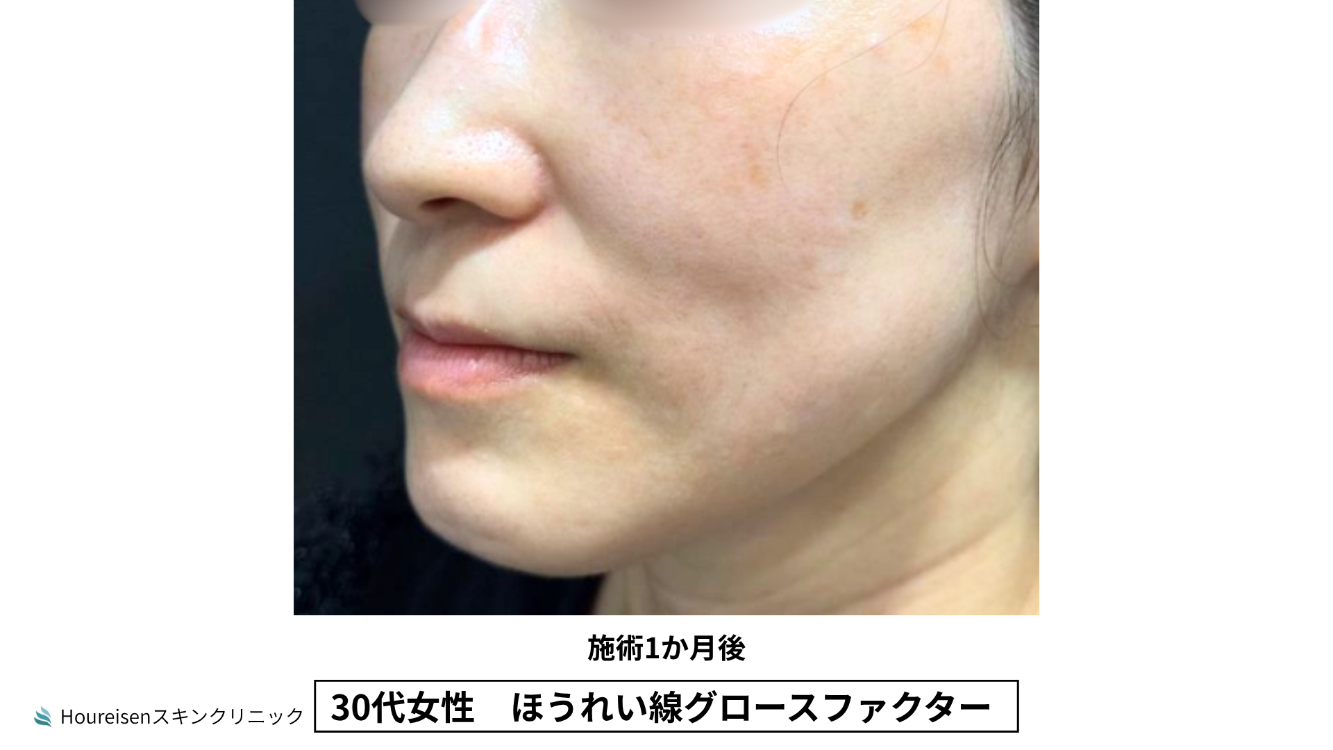 30代女性 ほうれい線グロースファクター施術3か月後