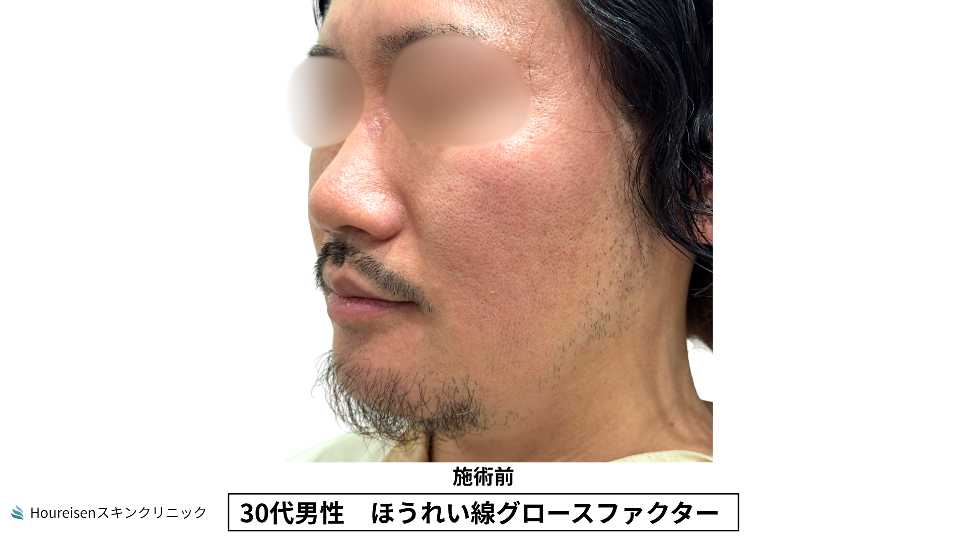 30代男性 ほうれい線 グロースファクター 施術前