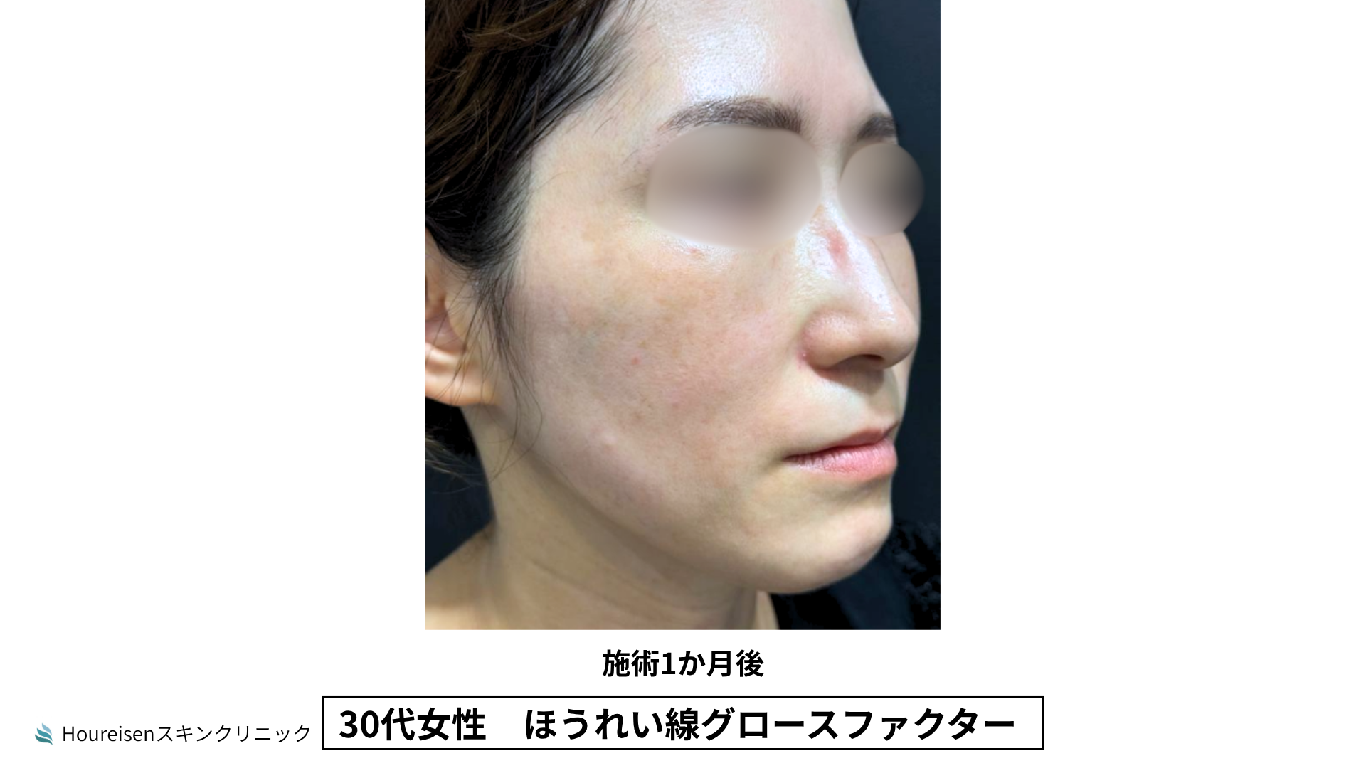 30代女性 ほうれい線グロースファクター施術3か月後