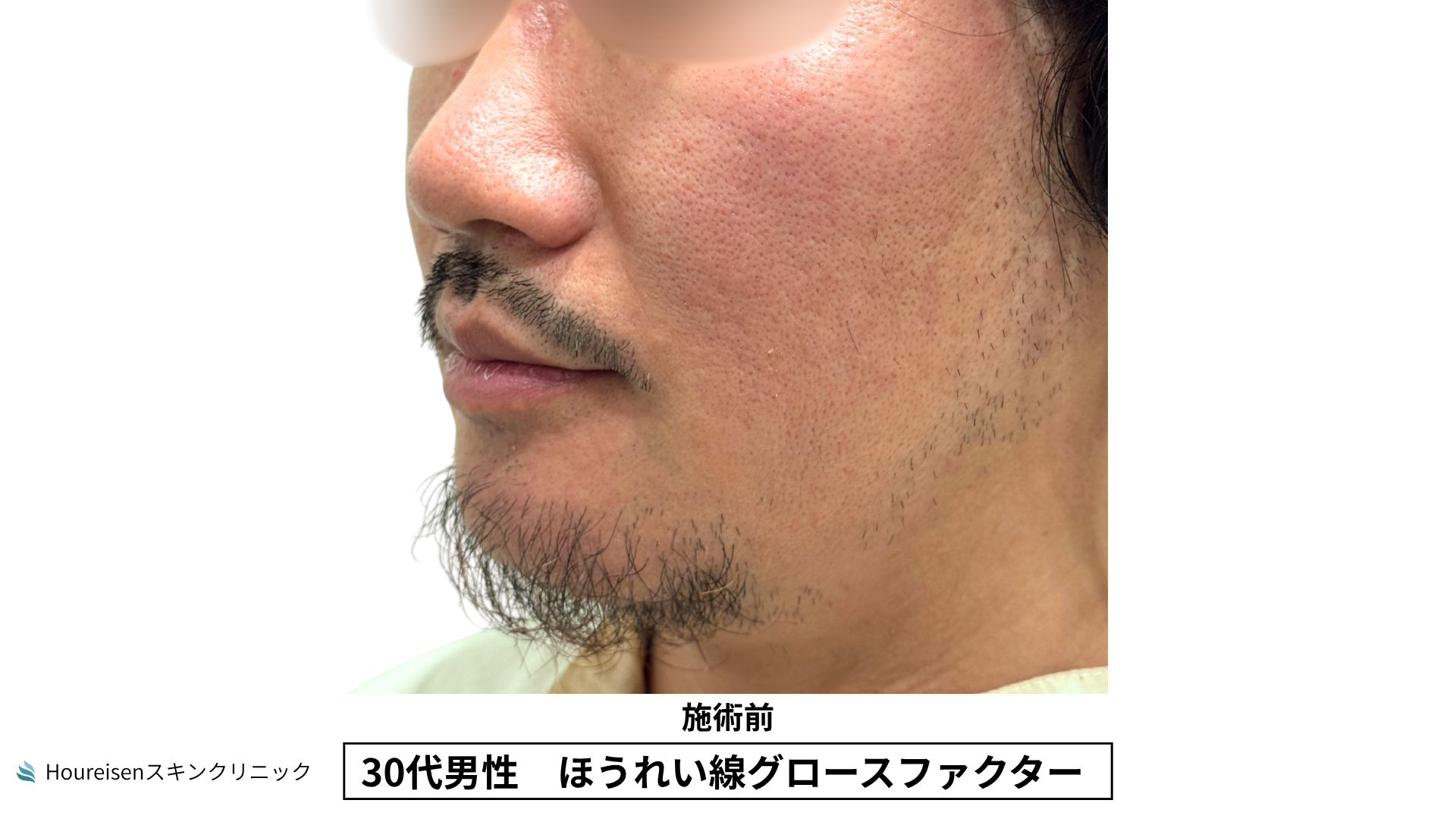 30代男性 ほうれい線 グロースファクター 施術前