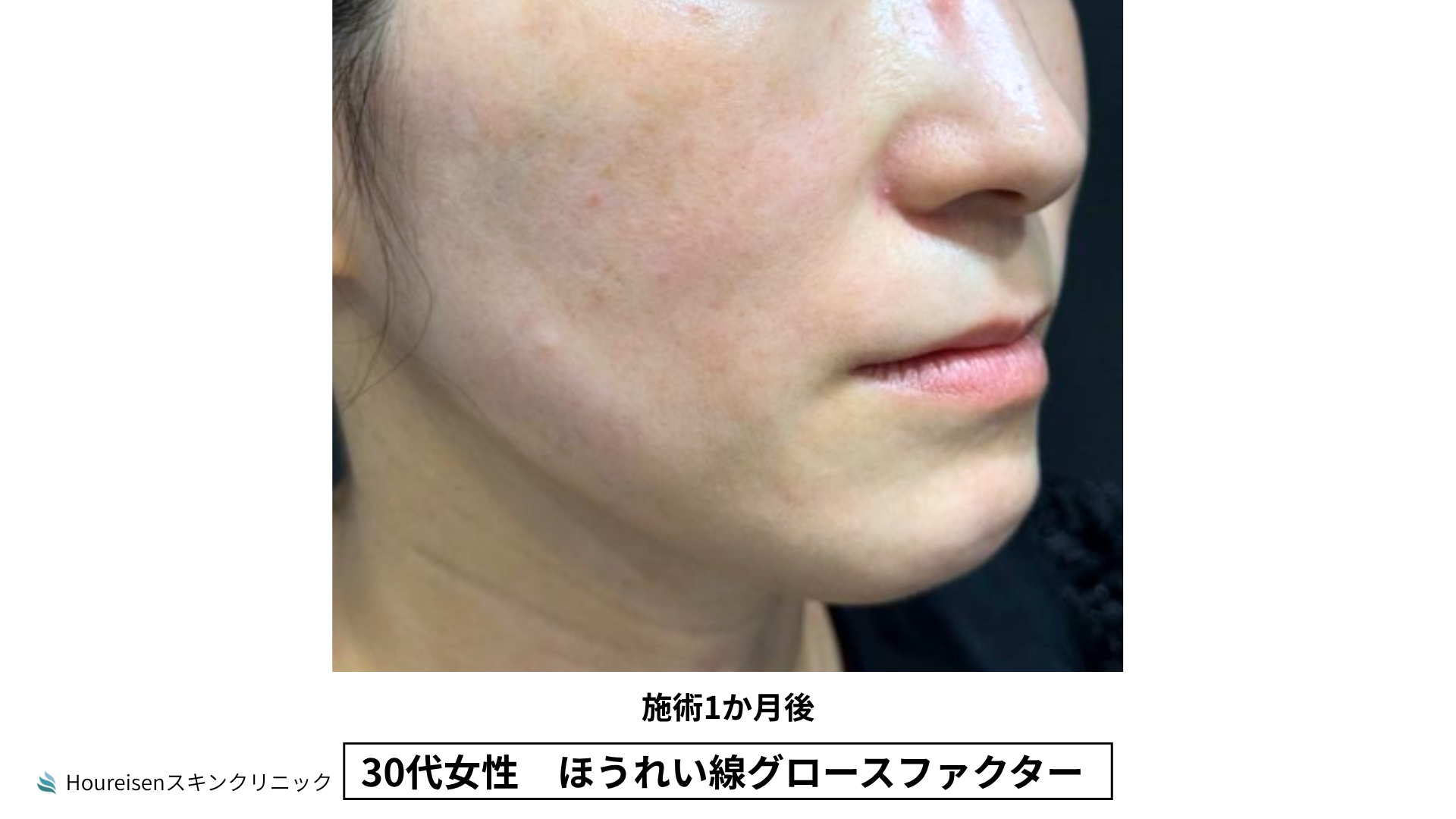 30代女性 ほうれい線グロースファクター施術3か月後