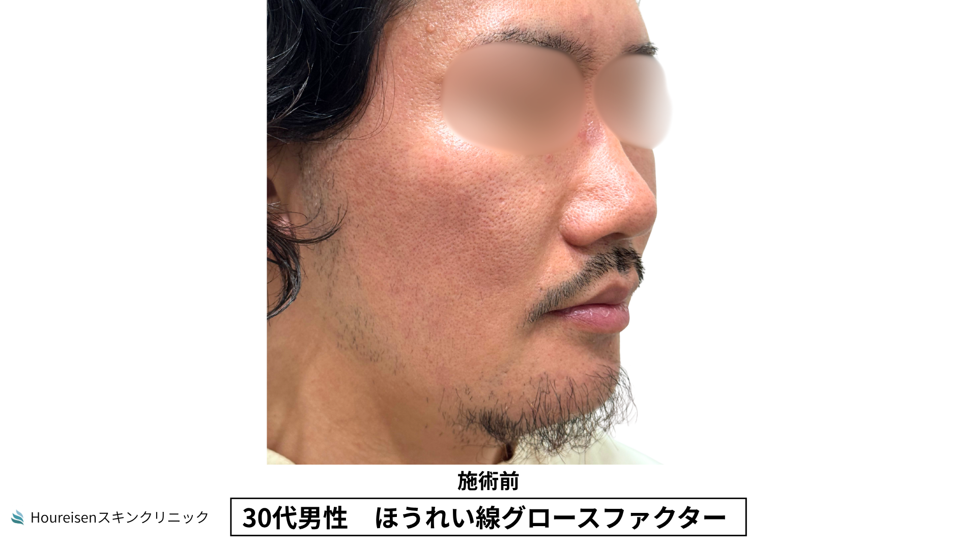 30代男性 ほうれい線 グロースファクター 施術前