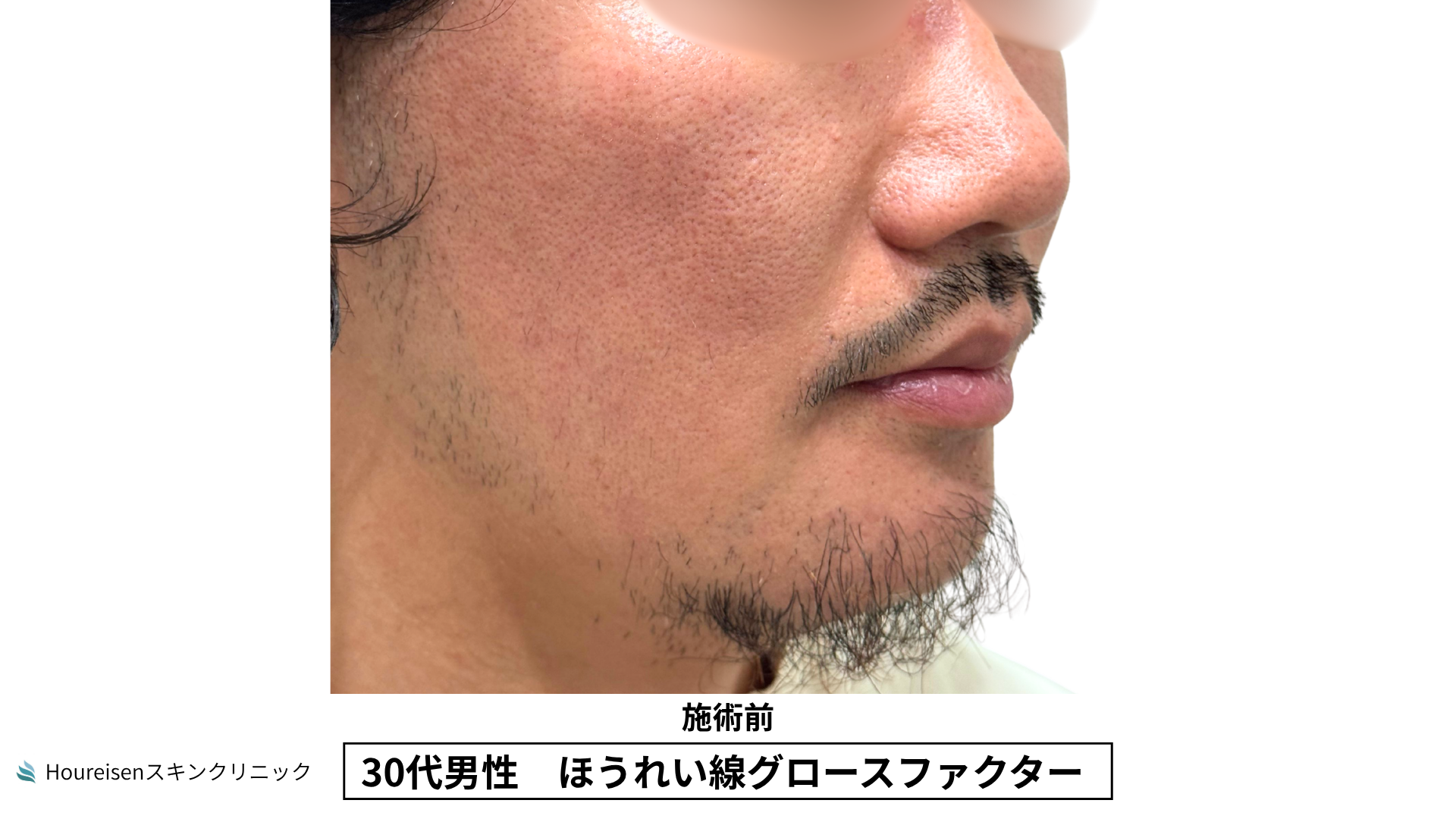 30代男性 ほうれい線 グロースファクター 施術前
