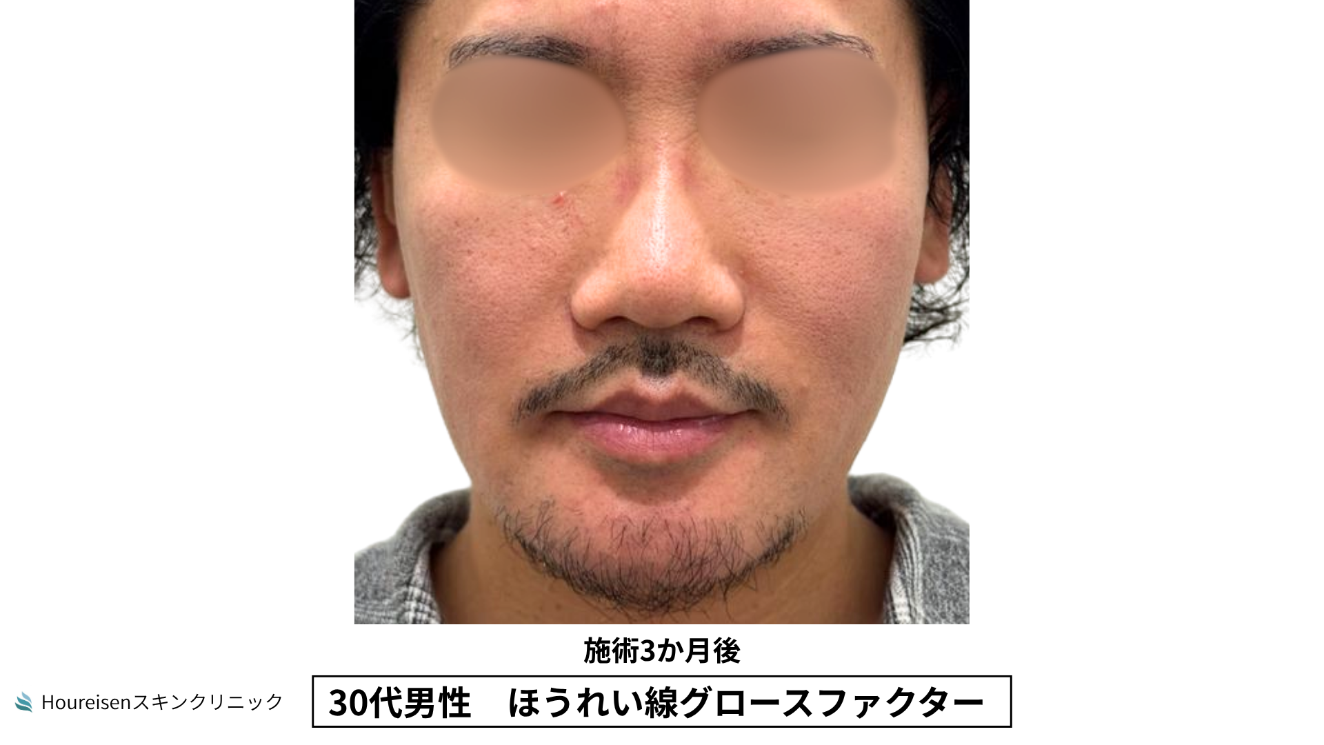 30代男性 ほうれい線 グロースファクター 施術3か月後