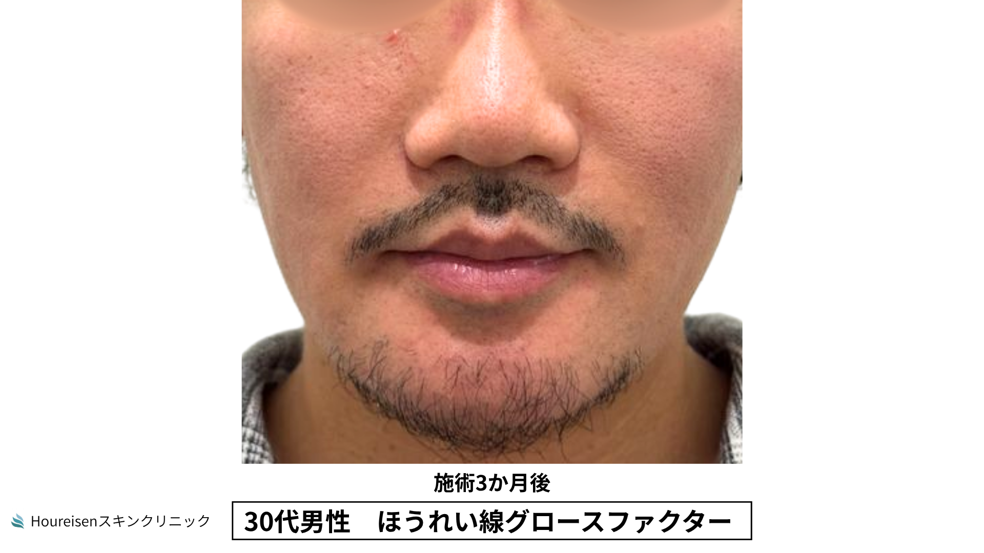 30代男性 ほうれい線 グロースファクター 施術3か月後