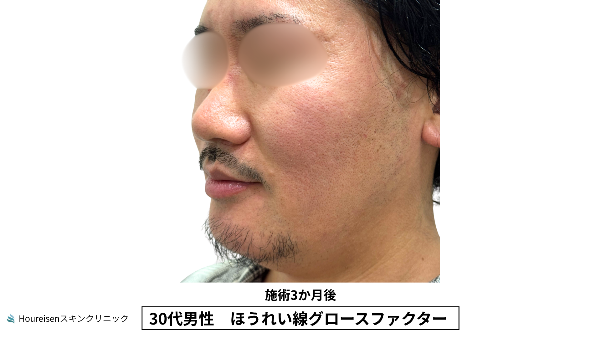 30代男性 ほうれい線 グロースファクター 施術3か月後