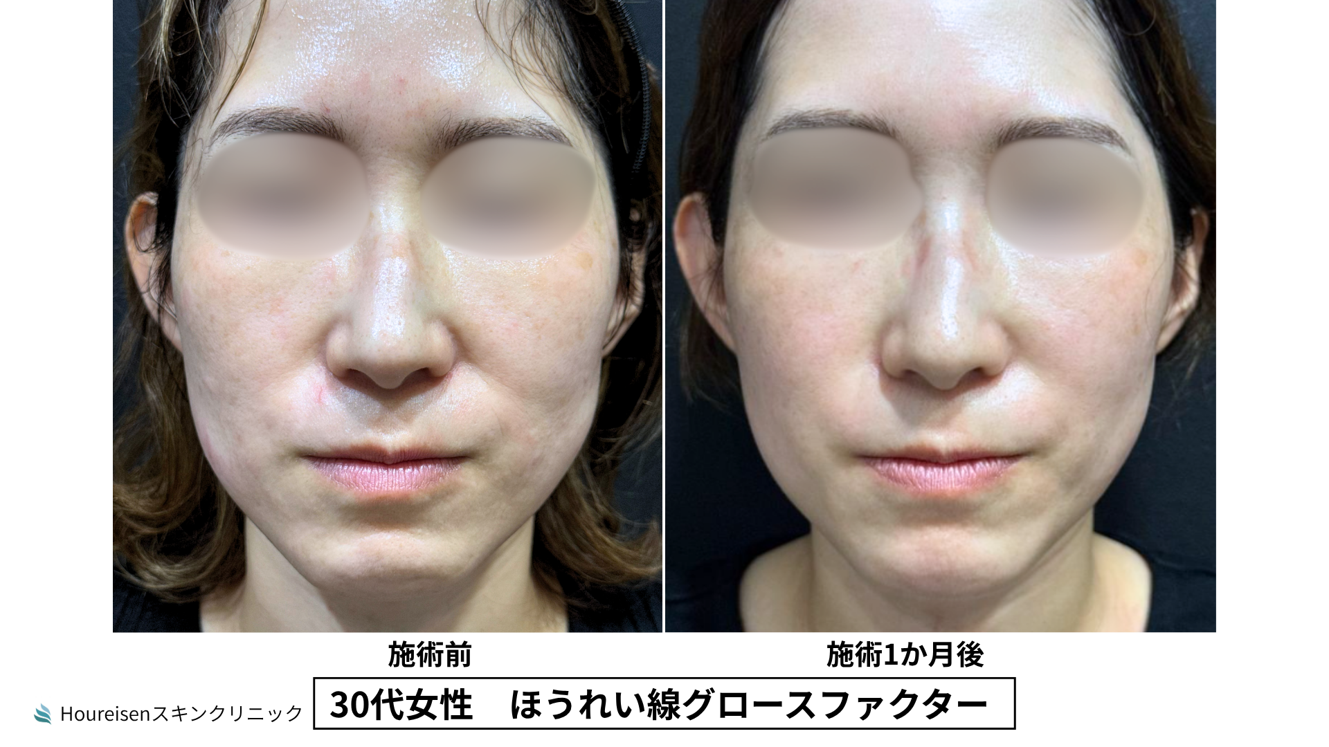 30代女性 グロースファクター3か月後 症例比較