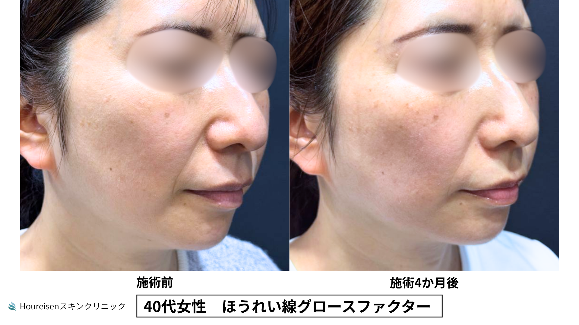40代女性 ほうれい線グロースファクター4か月後 症例比較