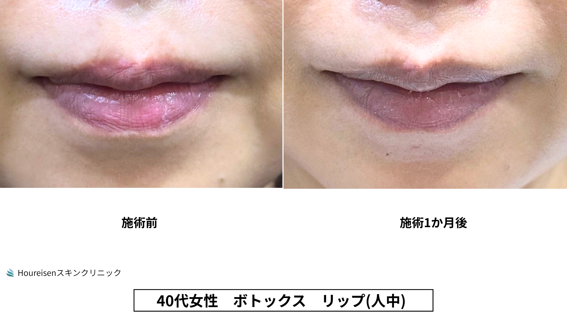 40代女性 リップ人中ボトックス 施術前と1か月後