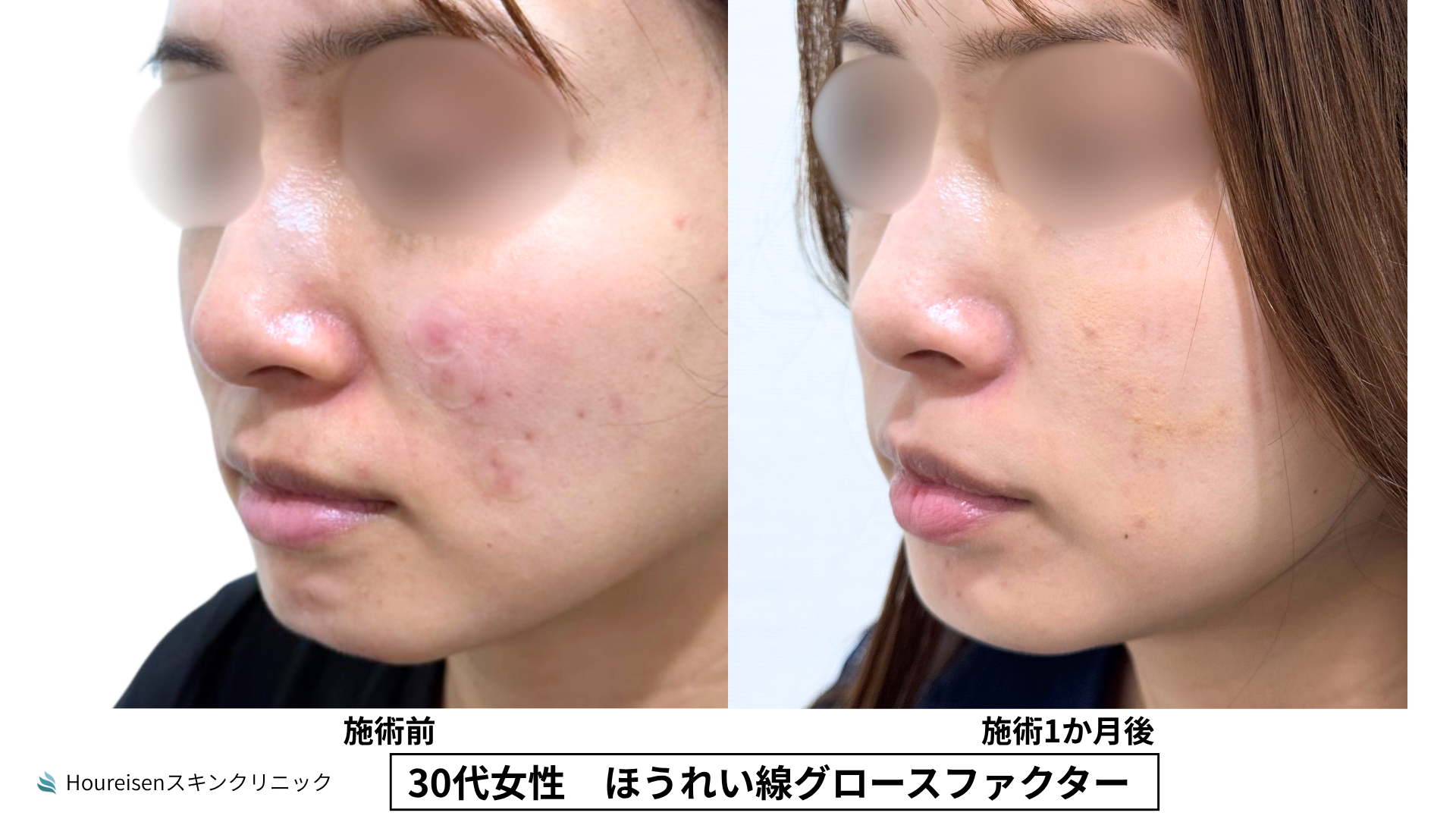 30代女性 ほうれい線グロースファクター症例比較