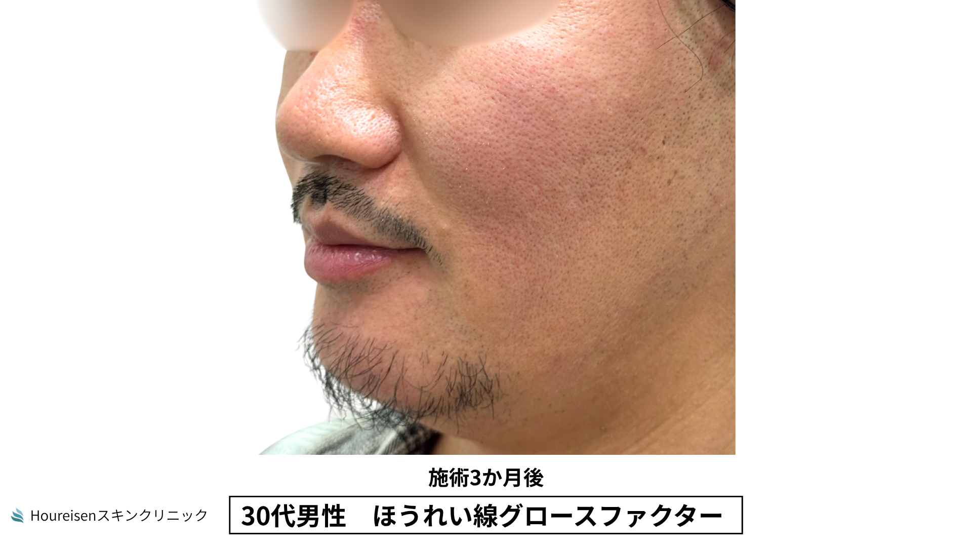 30代男性 ほうれい線 グロースファクター 施術3か月後