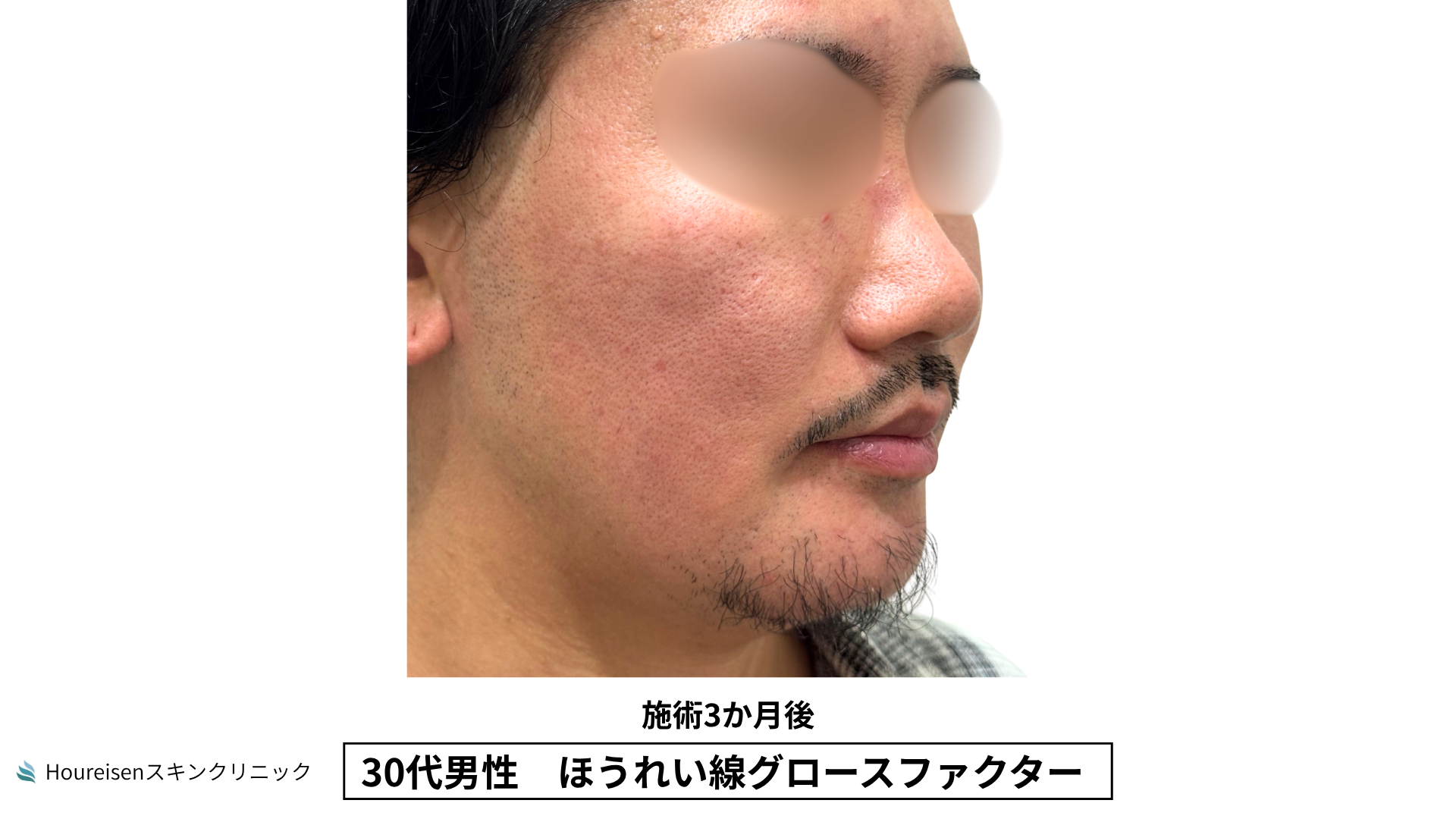 30代男性 ほうれい線 グロースファクター 施術3か月後