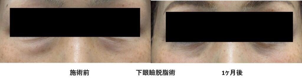 40代女性 目の下のクマ取り 下眼瞼脱脂術 施術前と1か月後 正面比較