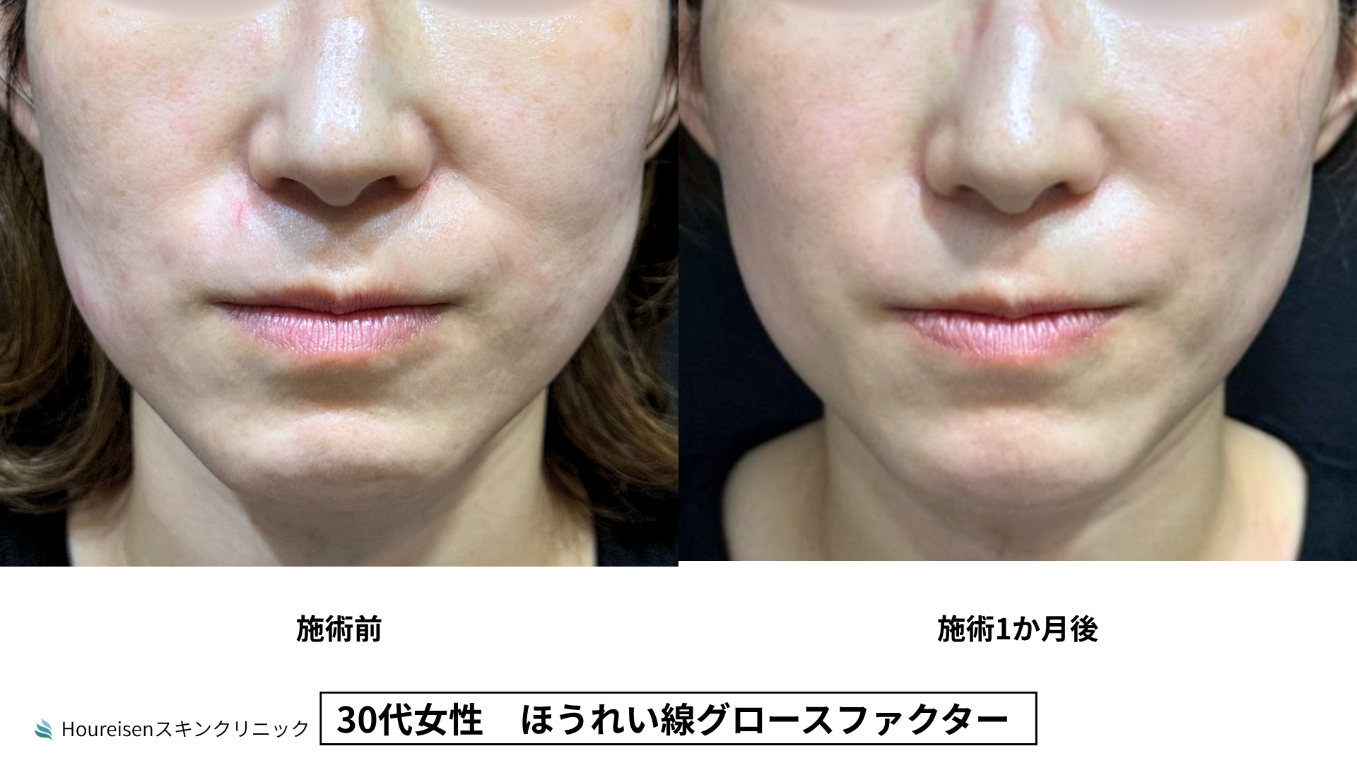 30代女性 グロースファクター3か月後 症例比較
