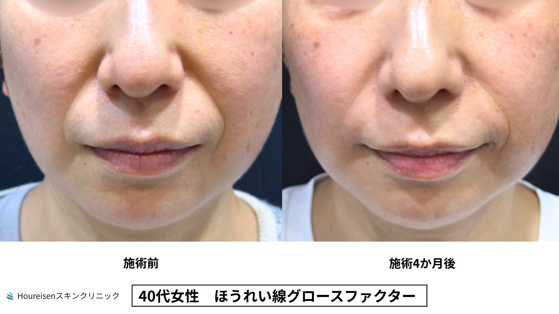 40代女性 ほうれい線グロースファクター4か月後 症例比較