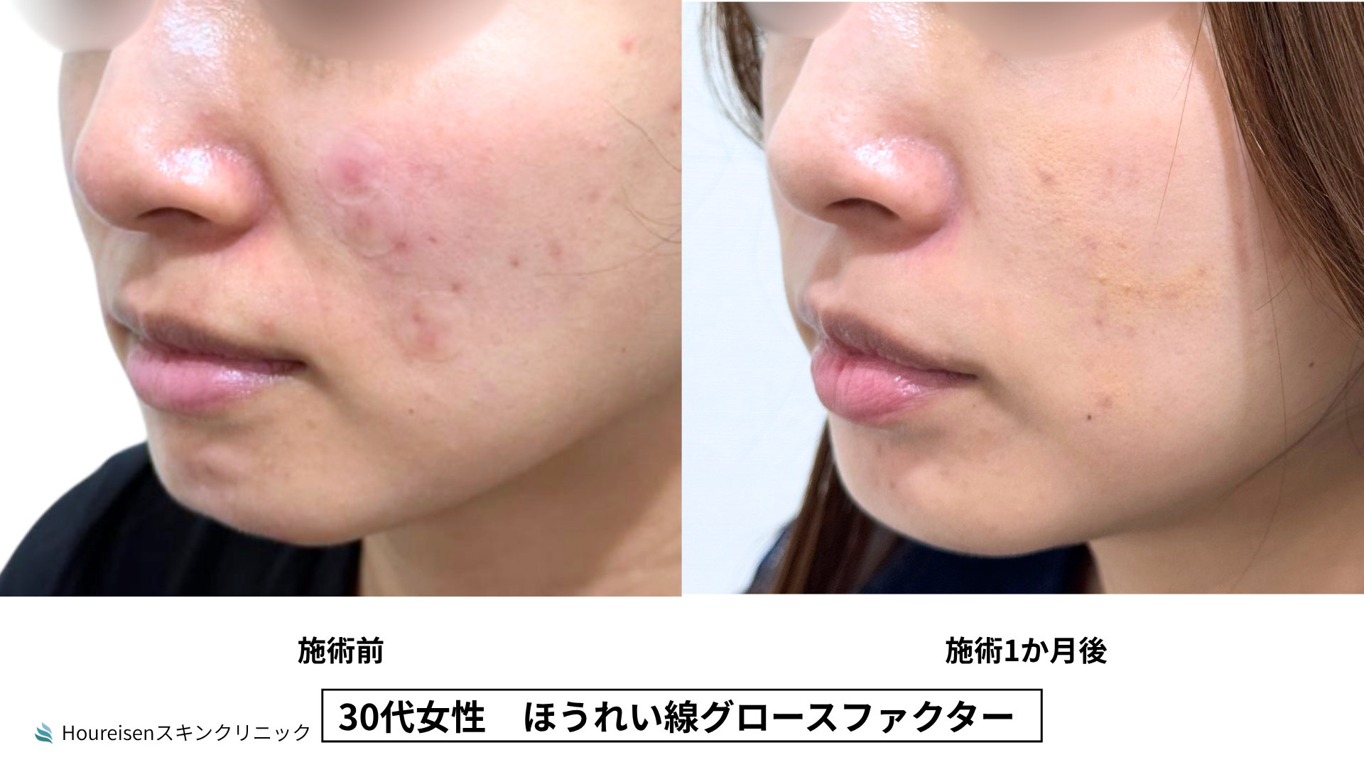 30代女性 ほうれい線グロースファクター症例比較