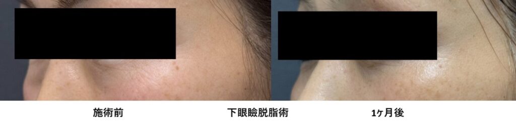 40代女性 目の下のクマ取り 下眼瞼脱脂術 施術前と1か月後 左側比較