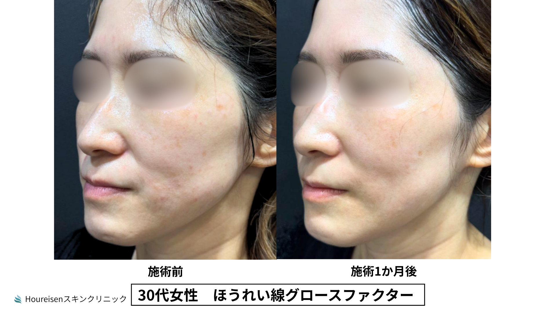 30代女性 グロースファクター3か月後 症例比較