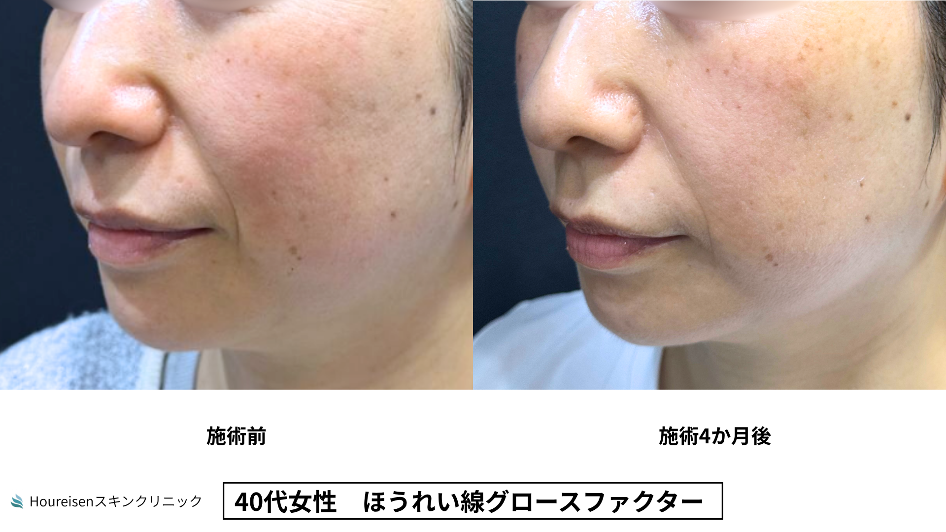 40代女性 ほうれい線グロースファクター4か月後 症例比較