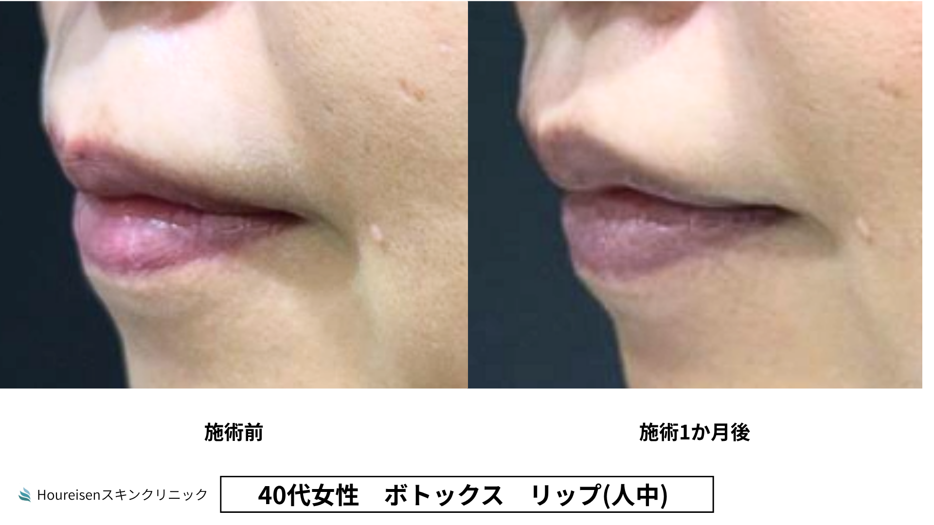 40代女性 リップ人中ボトックス 症例比較