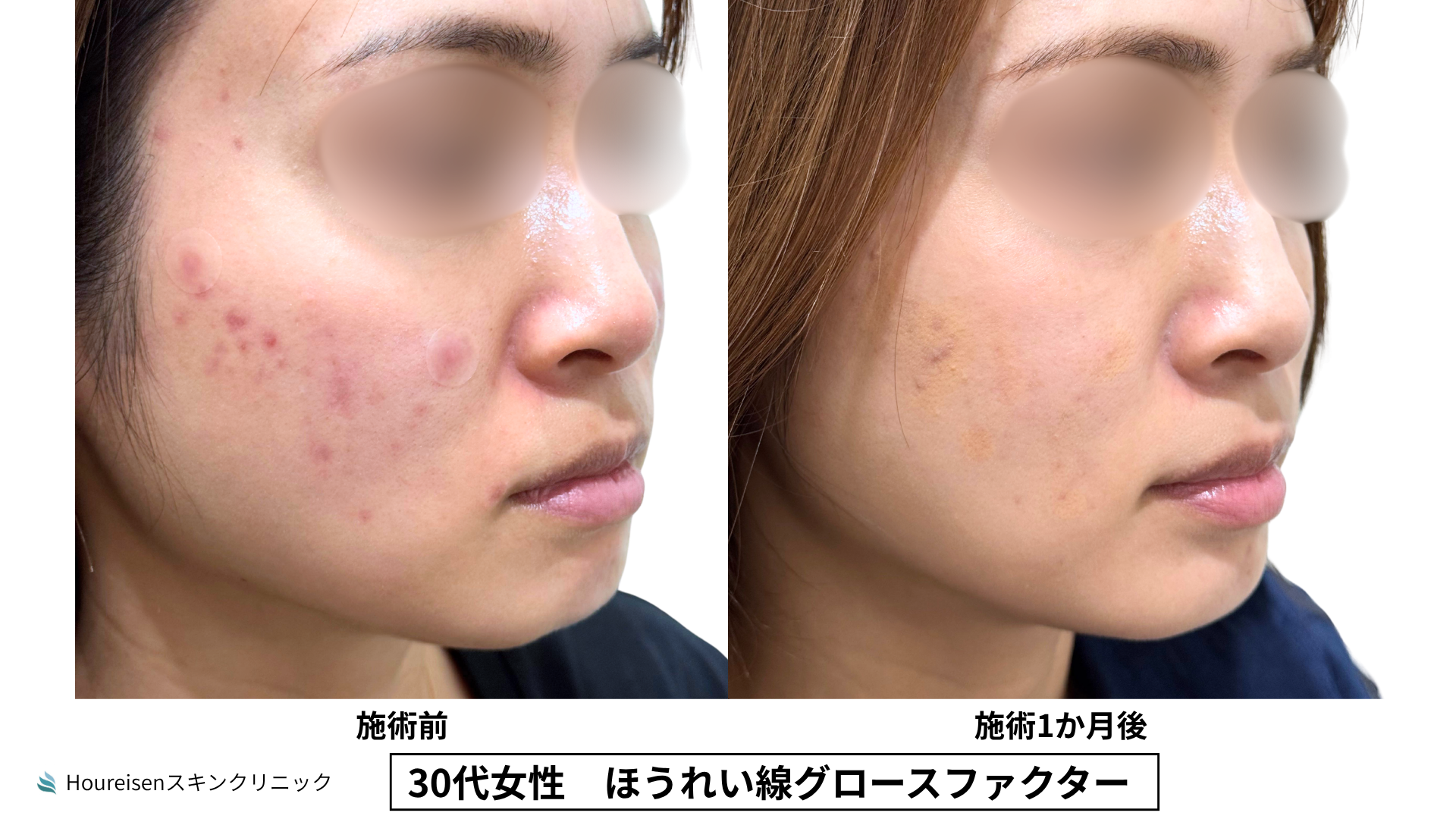 30代女性 ほうれい線グロースファクター症例比較