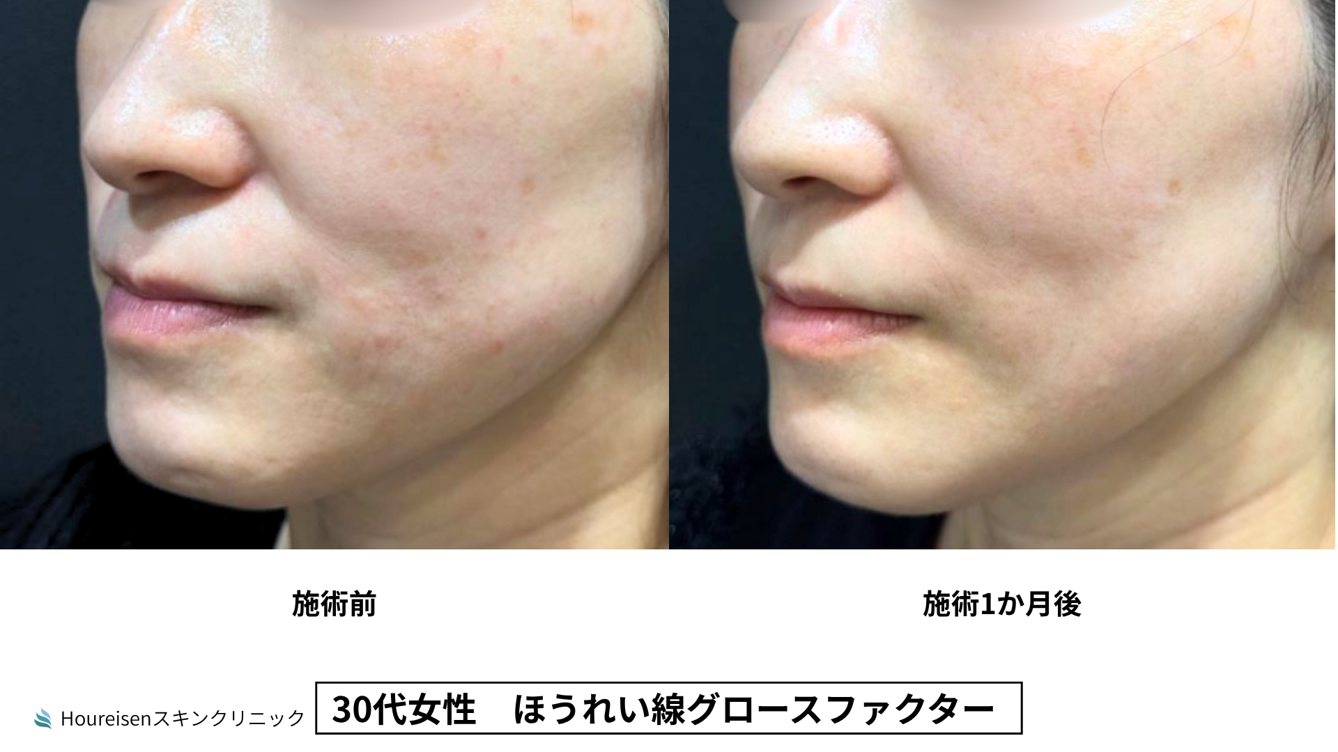 30代女性 グロースファクター3か月後 症例比較